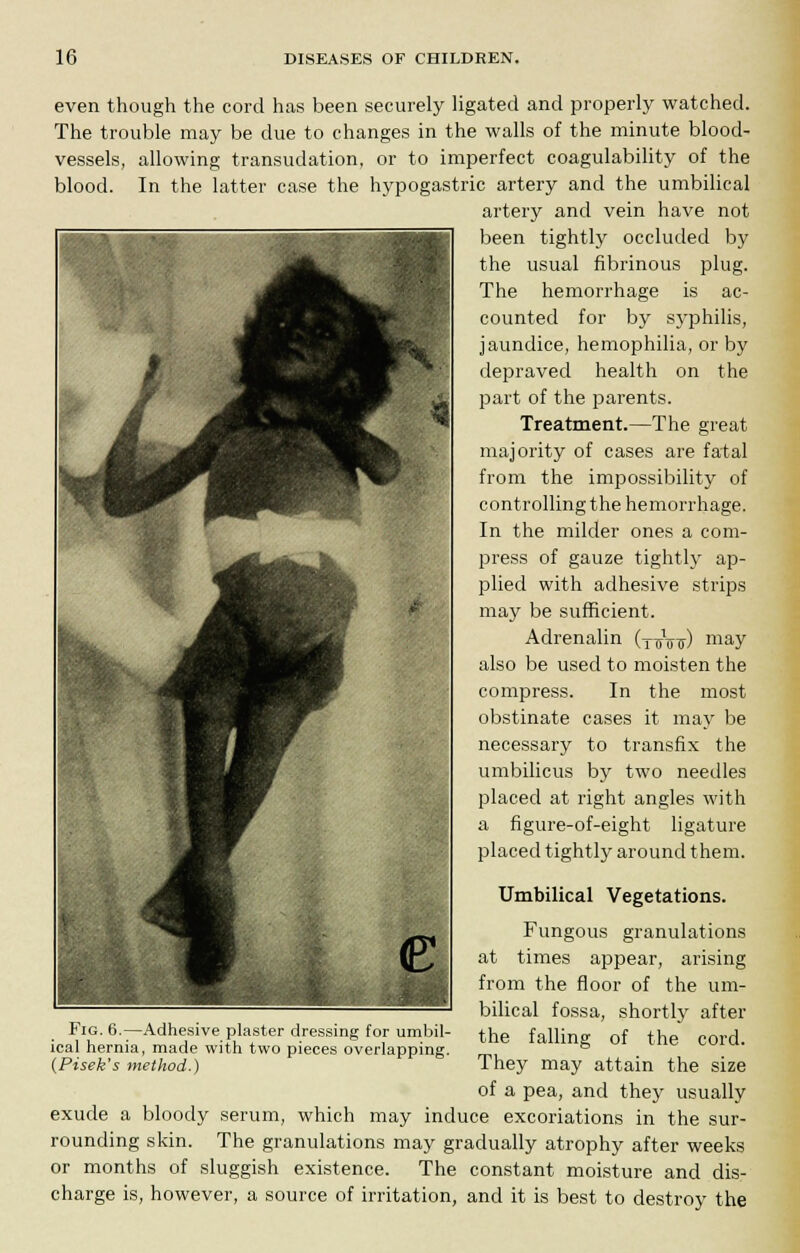 even though the cord has been securely ligated and properly watched. The trouble may be due to changes in the walls of the minute blood- vessels, allowing transudation, or to imperfect coagulability of the blood. In the latter case the hypogastric artery and the umbilical artery and vein have not been tightly occluded by the usual fibrinous plug. The hemorrhage is ac- counted for by syphilis, jaundice, hemophilia, or by depraved health on the part of the parents. Treatment.—The great majority of cases are fatal from the impossibility of controlling the hemorrhage. In the milder ones a com- press of gauze tightly ap- plied with adhesive strips may be sufficient. Adrenalin (TTnnr) may also be used to moisten the compress. In the most obstinate cases it may be necessary to transfix the umbilicus by two needles placed at right angles with a figure-of-eight ligature placed tightly around them. Umbilical Vegetations. Fungous granulations at times appear, arising from the floor of the um- bilical fossa, shortly after the falling of the cord. They may attain the size of a pea, and they usually exude a bloody serum, which may induce excoriations in the sur- rounding skin. The granulations may gradually atrophy after weeks or months of sluggish existence. The constant moisture and dis- charge is, however, a source of irritation, and it is best to destroy the B\ KT •: 1 -M- 1 1 <c Fig. 6.—Adhesive plaster dressing for umbil- ical hernia, made with two pieces overlapping. (Pisek's method.)