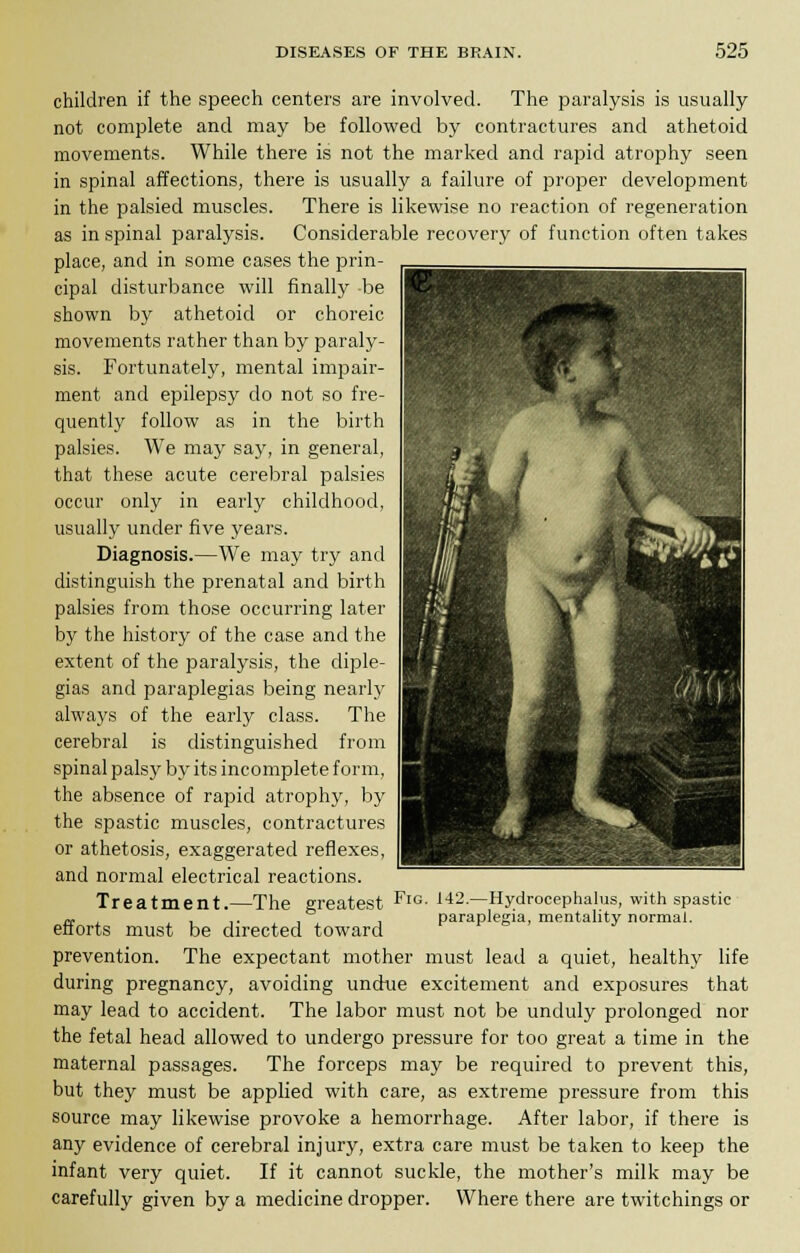 children if the speech centers are involved. The paralysis is usually not complete and may be followed by contractures and athetoid movements. While there is not the marked and rapid atrophy seen in spinal affections, there is usually a failure of proper development in the palsied muscles. There is likewise no reaction of regeneration as in spinal paralysis. Considerable recovery of function often takes place, and in some cases the prin- cipal disturbance will finally be shown by athetoid or choreic movements rather than by paraly- sis. Fortunately, mental impair- ment and epilepsy do not so fre- quently follow as in the birth palsies. We may say, in general, that these acute cerebral palsies occur only in early childhood, usually under five years. Diagnosis.—We may try and distinguish the prenatal and birth palsies from those occurring later by the history of the case and the extent of the paralysis, the diple- gias and paraplegias being nearly always of the early class. The cerebral is distinguished from spinal palsy by its incomplete form, the absence of rapid atrophy, by the spastic muscles, contractures or athetosis, exaggerated reflexes, and normal electrical reactions. Treatment.—The greatest FlG- 142.—Hydrocephalus, with spastic „. , ,. , , paraplegia, mentality normal, eflorts must be directed toward prevention. The expectant mother must lead a quiet, healthy life during pregnancy, avoiding undue excitement and exposures that may lead to accident. The labor must not be unduly prolonged nor the fetal head allowed to undergo pressure for too great a time in the maternal passages. The forceps may be required to prevent this, but they must be applied with care, as extreme pressure from this source may likewise provoke a hemorrhage. After labor, if there is any evidence of cerebral injury, extra care must be taken to keep the infant very quiet. If it cannot suckle, the mother's milk may be carefully given by a medicine dropper. Where there are twitchings or