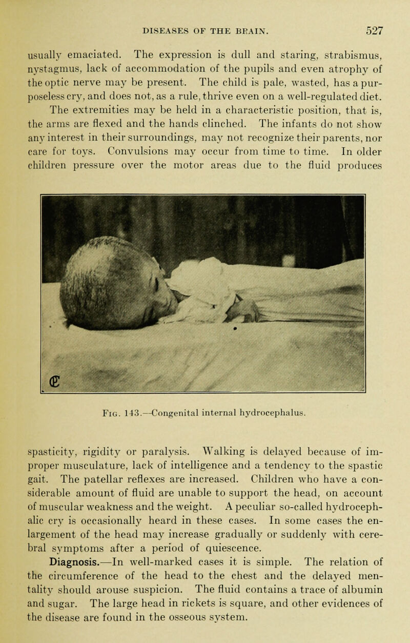 usually emaciated. The expression is dull and staring, strabismus, nystagmus, lack of accommodation of the pupils and even atrophy of the optic nerve may be present. The child is pale, wasted, has a pur- poseless cry, and does not, as a rule, thrive even on a well-regulated diet. The extremities may be held in a characteristic position, that is, the arms are flexed and the hands clinched. The infants do not show any interest in their surroundings, may not recognize their parents, nor care for toys. Convulsions may occur from time to time. In older children pressure over the motor areas due to the fluid produces Fig. 143.—Congenital internal hydrocephalus spasticity, rigidity or paralysis. Walking is delayed because of im- proper musculature, lack of intelligence and a tendency to the spastic gait. The patellar reflexes are increased. Children who have a con- siderable amount of fluid are unable to support the head, on account of muscular weakness and the weight. A peculiar so-called hydroceph- alic cry is occasionally heard in these cases. In some cases the en- largement of the head may increase gradually or suddenly with cere- bral symptoms after a period of quiescence. Diagnosis.—In well-marked cases it is simple. The relation of the circumference of the head to the chest and the delayed men- tality should arouse suspicion. The fluid contains a trace of albumin and sugar. The large head in rickets is square, and other evidences of the disease are found in the osseous system.