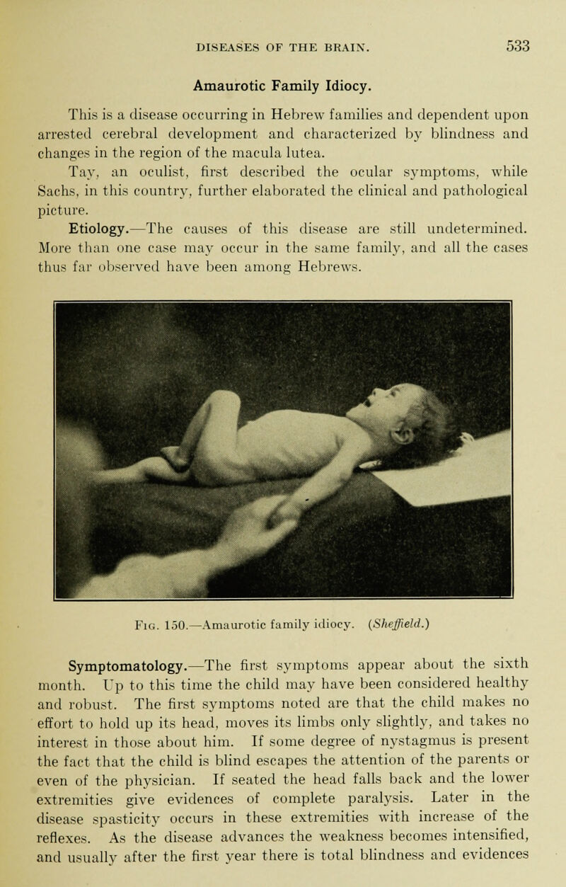 Amaurotic Family Idiocy. This is a disease occurring in Hebrew families and dependent upon arrested cerebral development and characterized by blindness and changes in the region of the macula lutea. Tay, an oculist, first described the ocular symptoms, while Sachs, in this country, further elaborated the clinical and pathological picture. Etiology.—The causes of this disease are still undetermined. More than one case may occur in the same family, and all the cases thus far observed have been among Hebrews. Fig. 150.—Amaurotic family idiocy. (Sheffield.) Symptomatology.—The first symptoms appear about the sixth month. Up to this time the child may have been considered healthy and robust. The first symptoms noted are that the child makes no effort to hold up its head, moves its limbs only slightly, and takes no interest in those about him. If some degree of nystagmus is present the fact that the child is blind escapes the attention of the parents or even of the physician. If seated the head falls back and the lower extremities give evidences of complete paralysis. Later in the disease spasticity occurs in these extremities with increase of the reflexes. As the disease advances the weakness becomes intensified, and usually after the first year there is total blindness and evidences