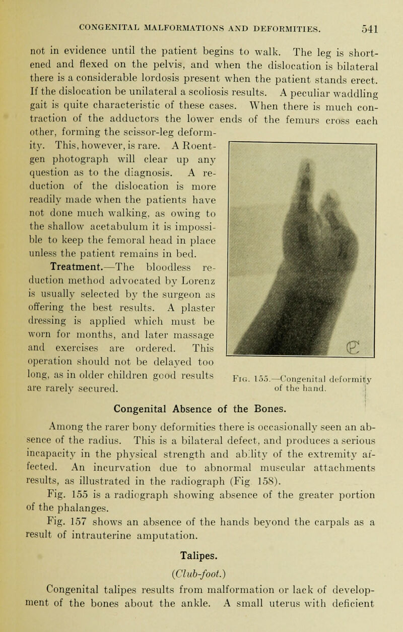 not in evidence until the patient begins to walk. The leg is short- ened and flexed on the pelvis, and when the dislocation is bilateral there is a considerable lordosis present when the patient stands erect. If the dislocation be unilateral a scoliosis results. A peculiar waddlino- gait is quite characteristic of these cases. When there is much con- traction of the adductors the lower ends of the femurs cross each other, forming the scissor-leg deform- ity. This, however, is rare. A Roent- gen photograph will clear up any question as to the diagnosis. A re- duction of the dislocation is more readily made when the patients have not done much walking, as owing to the shallow acetabulum it is impossi- ble to keep the femoral head in place unless the patient remains in bed. Treatment.—The bloodless re- duction method advocated by Lorenz is usually selected by the surgeon as offering the best results. A plaster dressing is applied which must be worn for months, and later massage and exercises are ordered. This operation should not be delayed too long, as in older children good results are rarely secured. Fig. 15.5 —Congenita] deformity of the hand. Congenital Absence of the Bones. Among the rarer bony deformities there is occasionally seen an ab- sence of the radius. This is a bilateral defect, and produces a serious incapacity in the physical strength and ability of the extremity af- fected. An incurvation due to abnormal muscular attachments results, as illustrated in the radiograph (Fig 15S). Fig. 155 is a radiograph showing absence of the greater portion of the phalanges. Fig. 157 shows an absence of the hands beyond the carpals as a result of intrauterine amputation. Talipes. (Club-foot.) Congenital talipes results from malformation or lack of develop- ment of the bones about the ankle. A small uterus with deficient