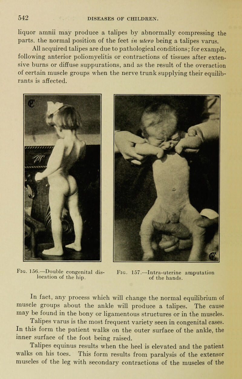 liquor amnii may produce a talipes by abnormally compressing the parts, the normal position of the feet in utero being a talipes varus. All acquired talipes are due to pathological conditions; for example, following anterior poliomyelitis or contractions of tissues after exten- sive burns or diffuse suppurations, and as the result of the overaction of certain muscle groups when the nerve trunk supplying their equilib- rants is affected. Fig. 156.—Double congenital dis- location of the hip. Fig. 157.—Intra-uterine amputation of the hands. In fact, any process which will change the normal equilibrium of muscle groups about the ankle will produce a talipes. The cause may be found in the bony or ligamentous structures or in the muscles. Talipes varus is the most frequent variety seen in congenital cases. In this form the patient walks on the outer surface of the ankle, the inner surface of the foot being raised. Talipes equinus results when the heel is elevated and the patient walks on his toes. This form results from paralysis of the extensor muscles of the leg with secondary contractions of the muscles of the