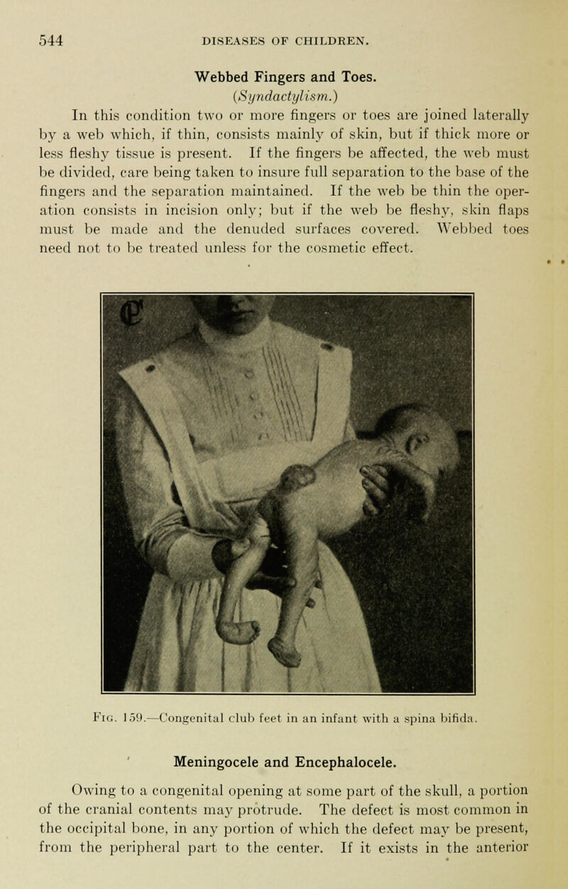 Webbed Fingers and Toes. (Syndactylism.) In this condition two or more fingers or toes are joined laterally by a web which, if thin, consists mainly of skin, but if thick more or less fleshy tissue is present. If the fingers be affected, the web must be divided, care being taken to insure full separation to the base of the fingers and the separation maintained. If the web be thin the oper- ation consists in incision only; but if the web be fleshy, skin flaps must be made and the denuded surfaces covered. Webbed toes need not to be treated unless for the cosmetic effect. t j Ei\ * l k, . w , 11 T * mm m 1 Fig. 159.—Congenital club feet in an infant with a spina bifida Meningocele and Encephalocele. Owing to a congenital opening at some part of the skull, a portion of the cranial contents may protrude. The defect is most common in the occipital bone, in any portion of which the defect may be present, from the peripheral part to the center. If it exists in the anterior