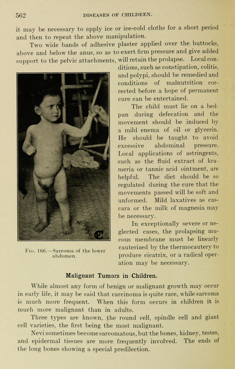 it may be necessary to apply ice or ice-cold cloths for a short period and then to repeat the above manipulation. Two wide bands of adhesive plaster applied over the buttocks, above and below the anus, so as to exert firm pressure and give added support to the pelvic attachments, will retain the prolapse. Local con- ditions, such as constipation, colitis, and polypi, should be remedied and conditions of malnutrition cor- rected before a hope of permanent cure can be entertained. The child must lie on a bed- pan during defecation and the movement should be induced by a mild enema of oil or glycerin. He should be taught to avoid excessive abdominal pressure. Local applications of astringents, such as the fluid extract of kra- meria or tannic acid ointment, are helpful. The diet should be so regulated during the cure that the movements passed will be soft and unformed. Mild laxatives as cas- cara or the milk of magnesia may be necessary. In exceptionally severe or ne- glected cases, the prolapsing mu- cous membrane must be linearly cauterized by the thermocautery to produce cicatrix, or a radical oper- ation may be necessary. t^H ' L tt ihMhfe tfi 1 *:-> i Fig. 166. -Sarcoma of the lower abdomen. Malignant Tumors in Children. While almost any form of benign or malignant growth may occur in early life, it may be said that carcinoma is quite rare, while sarcoma is much more frequent. When this form occurs in children it is much more malignant than in adults. Three types are known, the round cell, spindle cell and giant cell varieties, the first being the most malignant. Nevi sometimes become sarcomatous, but the bones, kidney, testes, and epidermal tissues are more frequently involved. The ends of the long bones showing a special predilection.