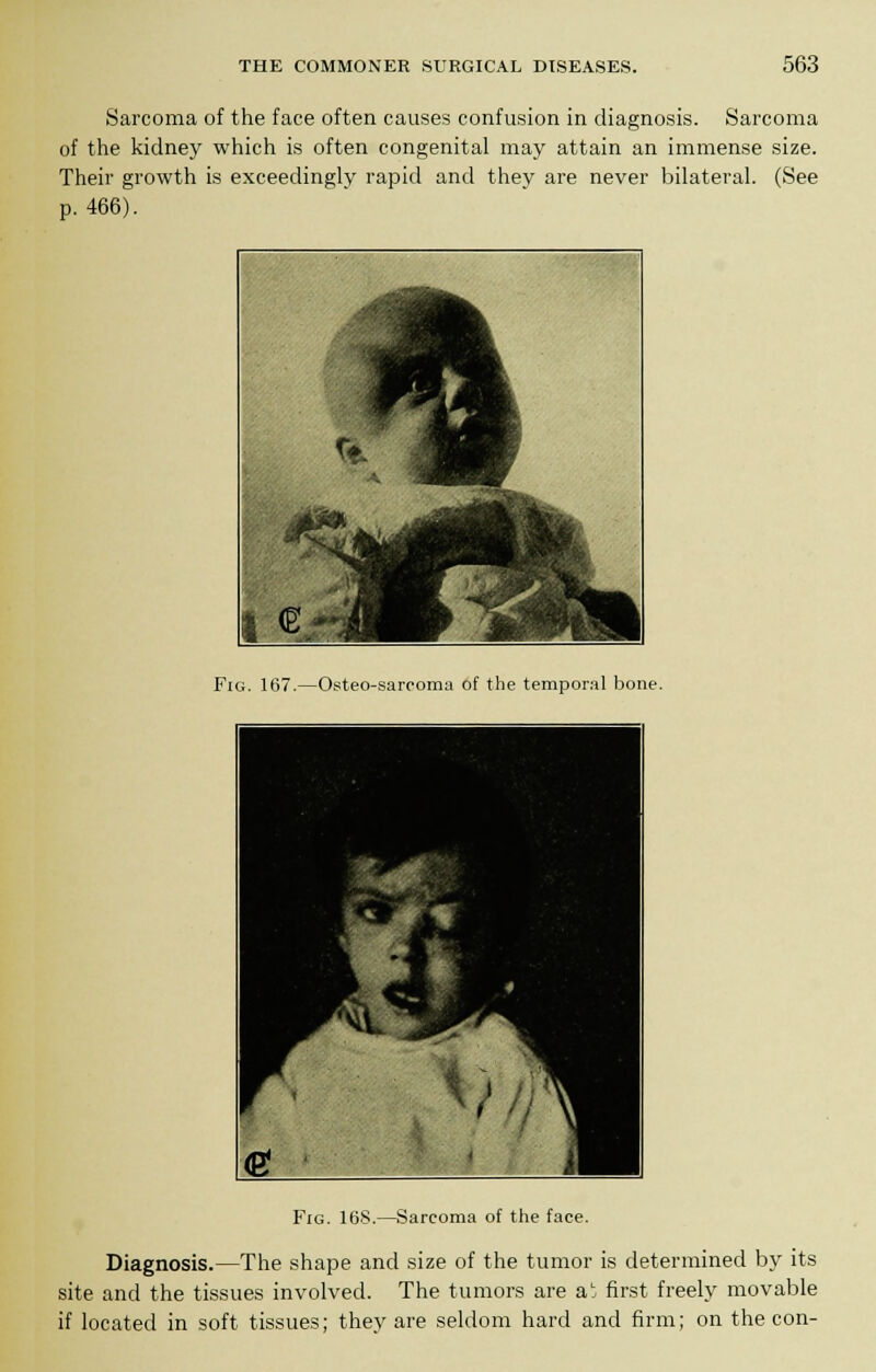 Sarcoma of the face often causes confusion in diagnosis. Sarcoma of the kidney which is often congenital may attain an immense size. Their growth is exceedingly rapid and they are never bilateral. (See p. 466). Fig. 167.—Osteosarcoma of the temporal bone. Fig. 168.—Sarcoma of the face. Diagnosis.—The shape and size of the tumor is determined by its site and the tissues involved. The tumors are at first freely movable if located in soft tissues; thev are seldom hard and firm; on the con-