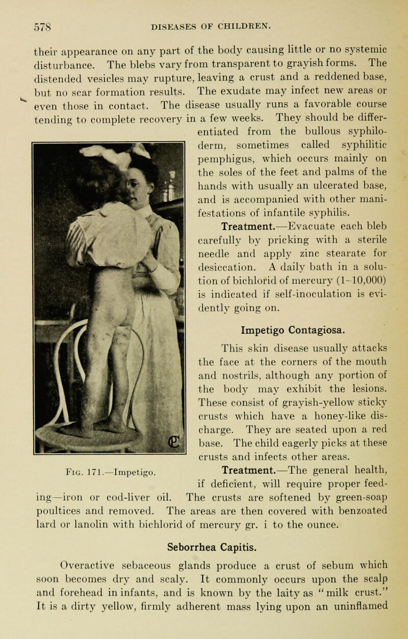 their appearance on any part of the body causing little or no systemic disturbance. The blebs vary from transparent to grayish forms. The distended vesicles may rupture, leaving a crust and a reddened base, but no scar formation results. The exudate may infect new areas or even those in contact. The disease usually runs a favorable course tending to complete recovery in a few weeks. They should be differ- entiated from the bullous syphilo- derm, sometimes called syphilitic pemphigus, which occurs mainly on the soles of the feet and palms of the hands with usually an ulcerated base, and is accompanied with other mani- festations of infantile syphilis. Treatment.—Evacuate each bleb carefully by pricking with a sterile needle and apply zinc stearate for desiccation. A daily bath in a solu- tion of bichlorid of mercury (1-10,000) is indicated if self-inoculation is evi- dently going on. Impetigo Contagiosa. This skin disease usually attacks the face at the corners of the mouth and nostrils, although any portion of the body may exhibit the lesions. These consist of grayish-yellow sticky crusts which have a honey-like dis- charge. They are seated upon a red fc^. Hfij base. The child eagerly picks at these crusts and infects other areas. Treatment.—The general health, if deficient, will require proper feed- ing—iron or cod-liver oil. The crusts are softened by green-soap poultices and removed. The areas are then covered with benzoated lard or lanolin with bichlorid of mercury gr. i to the ounce. Seborrhea Capitis. Overactive sebaceous glands produce a crust of sebum which soon becomes dry and scaly. It commonly occurs upon the scalp and forehead in infants, and is known by the laity as  milk crust. It is a dirty yellow, firmly adherent mass lying upon an uninflamed Fig. 171.—Impetigo.