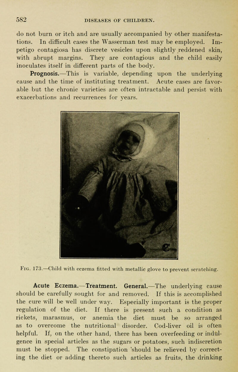 do not burn or itch and are usually accompanied by other manifesta- tions. In difficult cases the Wasserman test may be employed. Im- petigo contagiosa has discrete vesicles upon slightly reddened skin, with abrupt margins. They are contagious and the child easily inoculates itself in different parts of the body. Prognosis.—This is variable, depending upon the underlying cause and the time of instituting treatment. Acute cases are favor- able but the chronic varieties are often intractable and persist with exacerbations and recurrences for years. Fig. 173.—Child with eczema fitted with metallic glove to prevent scratching. Acute Eczema.—Treatment. General.—The underlying cause should be carefully sought for and removed. If this is accomplished the cure will be well under way. Especially important is the proper regulation of the diet. If there is present such a condition as rickets, marasmus, or anemia the diet must be so arranged as to overcome the nutritional disorder. Cod-liver oil is often helpful. If, on the other hand, there has been overfeeding or indul- gence in special articles as the sugars or potatoes, such indiscretion must be stopped. The constipation 'should be relieved by correct- ing the diet or adding thereto such articles as fruits, the drinking
