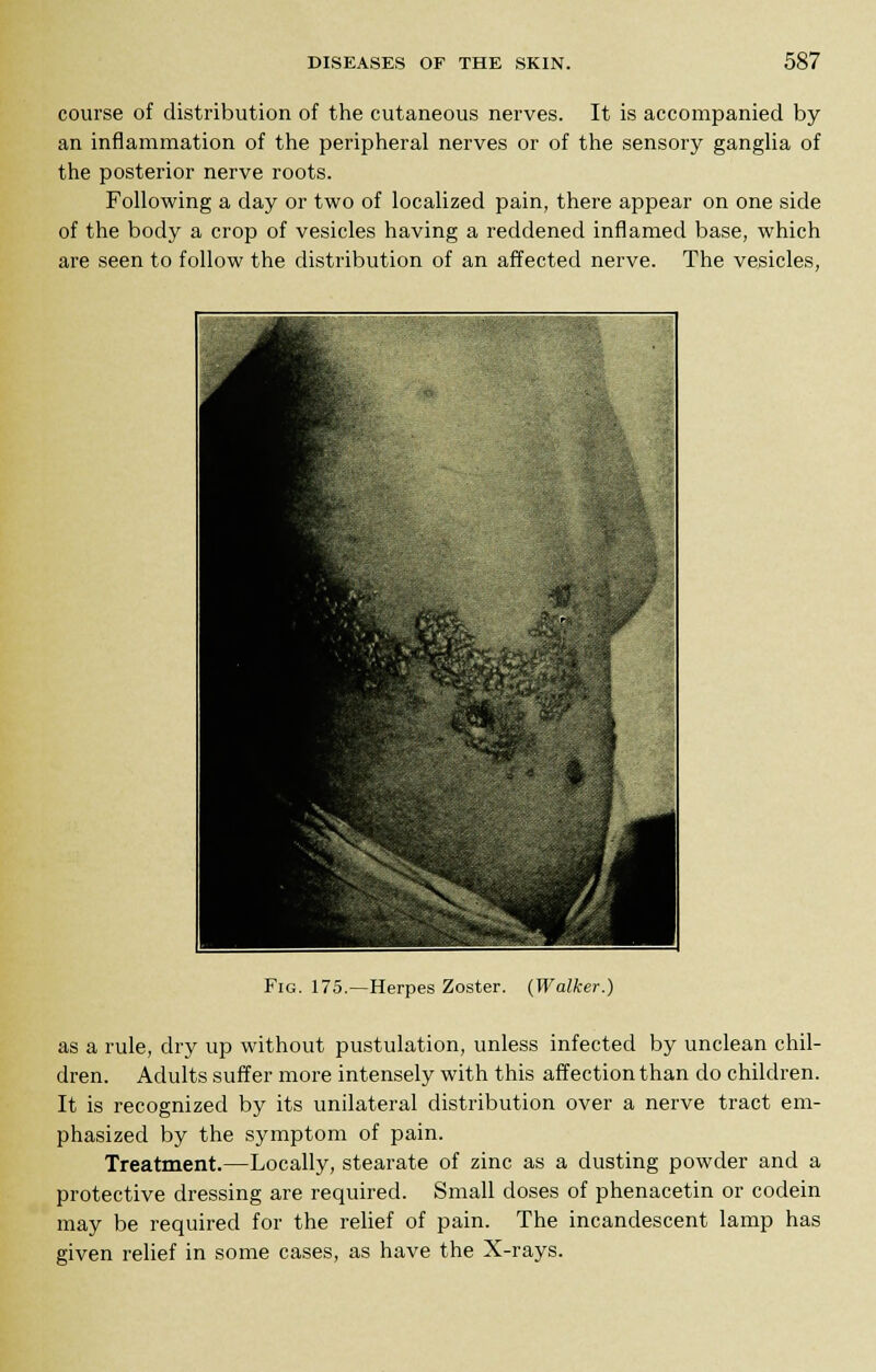 course of distribution of the cutaneous nerves. It is accompanied by an inflammation of the peripheral nerves or of the sensory ganglia of the posterior nerve roots. Following a day or two of localized pain, there appear on one side of the body a crop of vesicles having a reddened inflamed base, which are seen to follow the distribution of an affected nerve. The vesicles, Fig. 175.—Herpes Zoster. (Walker.) as a rule, dry up without pustulation, unless infected by unclean chil- dren. Adults suffer more intensely with this affection than do children. It is recognized by its unilateral distribution over a nerve tract em- phasized by the symptom of pain. Treatment.—Locally, stearate of zinc as a dusting powder and a protective dressing are required. Small doses of phenacetin or codein may be required for the relief of pain. The incandescent lamp has given relief in some cases, as have the X-rays.