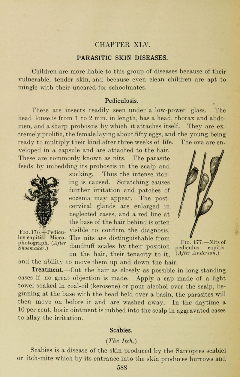 CHAPTER XLV. PARASITIC SKIN DISEASES. Children are more liable to this group of diseases because of their vulnerable, tender skin, and because even clean children are apt to mingle with their uncared-for schoolmates. Pediculosis. These are insects readily seen under a low-power glass. The head louse is from 1 to 2 mm. in length, has a head, thorax and abdo- men, and a sharp proboscis by which it attaches itself. They are ex- tremely prolific, the female laying about fifty eggs, and the young being ready to multiply their kind after three weeks of life. The ova are en- veloped in a capsule and are attached to the hair. These are commonly known as nits. The parasite feeds by imbedding its proboscis in the scalp and sucking. Thus the intense itch- ing is caused. Scratching causes further irritation and patches of eczema may appear. The post- cervical glands are enlarged in neglected cases, and a reel line at the base of the hair behind is often visible to confirm the diagnosis. The nits are distinguishable from dandruff scales by their position on the hair, their tenacity to it, and the ability to move them up and down the hair. Treatment.—Cut the hair as closely as possible in long-standing cases if no great objection is made. Apply a cap made of a light towel soaked in coal-oil (kerosene) or pour alcohol over the scalp, be- ginning at the base with the head held over a basin, the parasites will then move on before it and are washed away. In the daytime a 10 per cent, boric ointment is rubbed into the scalp in aggravated cases to allay the irritation. Scabies. (The Itch.) Scabies is a disease of the skin produced by the Sarcoptes scabiei or itch-mite which by its entrance into the skin produces burrows and 588 Fig. 176.—Pedicu- lus capitis. Micro- photograph. (After Shoemaker.) Fig. 177.—Nits of pediculus capitis. (After Anderson.)