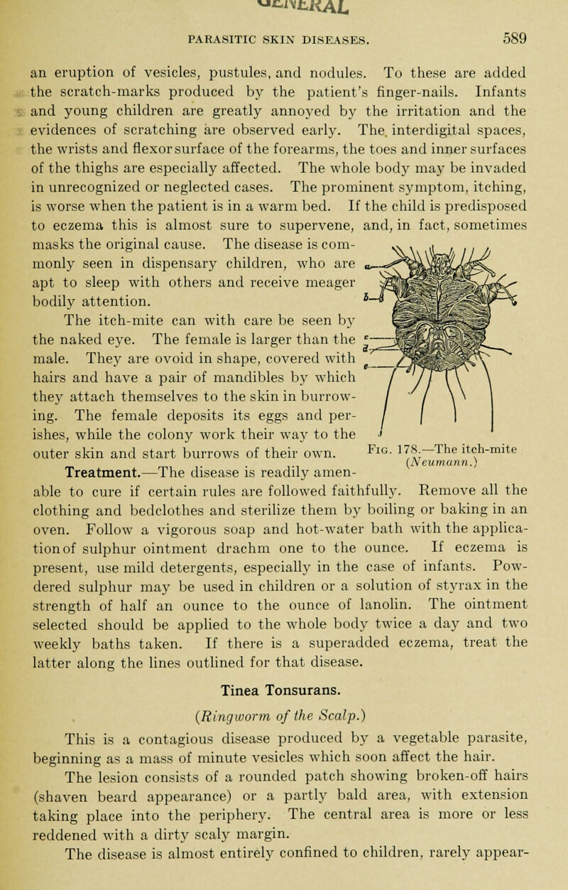 an eruption of vesicles, pustules, and nodules. To these are added the scratch-marks produced by the patient's finger-nails. Infants and young children are greatly annoyed by the irritation and the evidences of scratching are observed early. The. interdigital spaces, the wrists and flexor surface of the forearms, the toes and inner surfaces of the thighs are especially affected. The whole body may be invaded in unrecognized or neglected cases. The prominent symptom, itching, is worse when the patient is in a warm bed. If the child is predisposed to eczema this is almost sure to supervene, and, in fact, sometimes masks the original cause. The disease is com- monly seen in dispensary children, who are apt to sleep with others and receive meager bodily attention. The itch-mite can with care be seen by the naked eye. The female is larger than the male. They are ovoid in shape, covered with hairs and have a pair of mandibles by which they attach themselves to the skin in burrow- ing. The female deposits its eggs and per- ishes, while the colony work their way to the •»' outer skin and start burrows of their own. FlG- 178.—The itch-mite (Neumann.) Treatment.—The disease is readily amen- able to cure if certain rules are followed faithfully. Remove all the clothing and bedclothes and sterilize them by boiling or baking in an oven. Follow a vigorous soap and hot-water bath with the applica- tion of sulphur ointment drachm one to the ounce. If eczema is present, use mild detergents, especially in the case of infants. Pow- dered sulphur may be used in children or a solution of styrax in the strength of half an ounce to the ounce of lanolin. The ointment selected should be applied to the whole body twice a day and two weekly baths taken. If there is a superadded eczema, treat the latter along the lines outlined for that disease. Tinea Tonsurans. (Ringworm of the Scalp.) This is a contagious disease produced by a vegetable parasite, beginning as a mass of minute vesicles which soon affect the hair. The lesion consists of a rounded patch showing broken-off hairs (shaven beard appearance) or a partly bald area, with extension taking place into the periphery. The central area is more or less reddened with a dirty scaly margin. The disease is almost entirely confined to children, rarely appear-