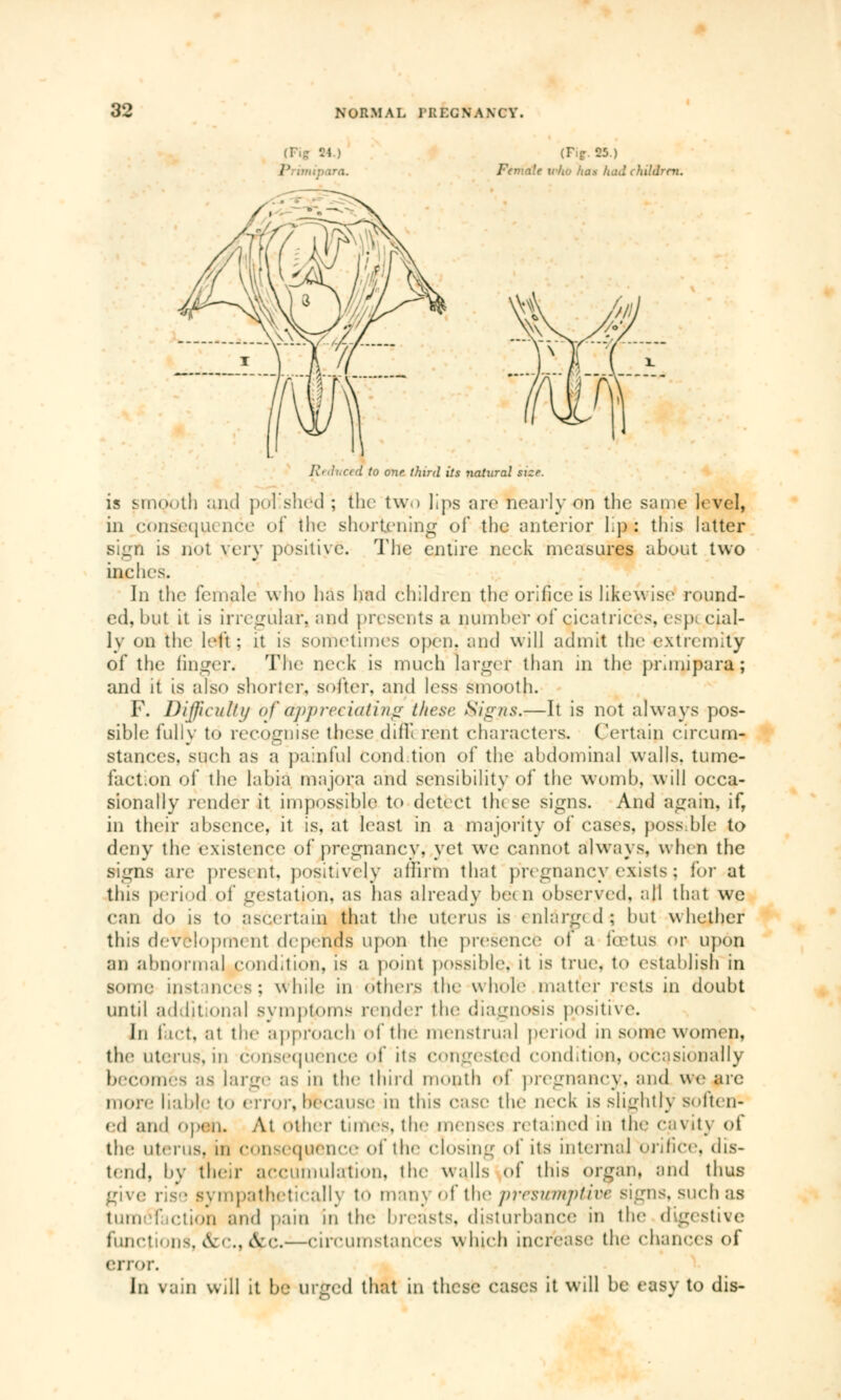 fPIg Cl I I {Tig. 25.) Female v/iu has had children. Reduced to one third its natural size. is smooth and polished ; the two lips are nearly on the same 1« vel, in consequence of the shortening of the anterior lip: this latter sign is riot very positive. The entire neck measures about two inches. In the female who has had children the orifice is likewise round- ed, but it is irregular, and presents a number of cicatrices. esp< dal- ly on the left : it is sometimes Open! and will admit the extremity of the finger. The neck is much target than in the pmnipara; and it is also shorter, softer, and less smooth. F. Difficulty of appreciating these Signs.—It is not always pos- sible fully to recognise these din! rent characters. Certain circum- stances, such as a painful Condition of the abdominal walls, tume- faction of the labia majora and sensibility of the womb, will occa- sionally render it impossible to detect these signs. And again, if, in their absence, it is, at least in a majority of cases, poss ble to deny the existence of pregnancy, yet we cannot always, when the signs are present, positively affirm that pregnancy, exists ; for at this period of gestation, as has already bet n observed. ;ill that we can do is to ascertain that the uterus is enlarged; but whether this development depends upon the presence of a foetus or upon an abnormal pondition, is a point possible, it is true, to establish in some instances; while in others the whole matter rests in doubt until additional symptoms render the diagnosis positive. In fact, at the approach of the menstrual period m some women, the uterus, in consequence of its congested condition, occasionally becomes as large as in the third month of pregnancy, and we are more liable t<> error, because m this ease the neck is slightly soften- ed and open. At other tunes, the menses retained in the cavity of the uterus, m consequence of the closing of its internal orifice, dis- tend, by their accumulation, the walls of this organ, and thus give rise sympathetically to many of the presumptive signs, such as tuméTaction and pain in the breasts, disturbance in the digestive functions, &c, cVc.—eireumstanees which increase the chances of error. In vain will it be urged that in these cases it will be easy to dis-