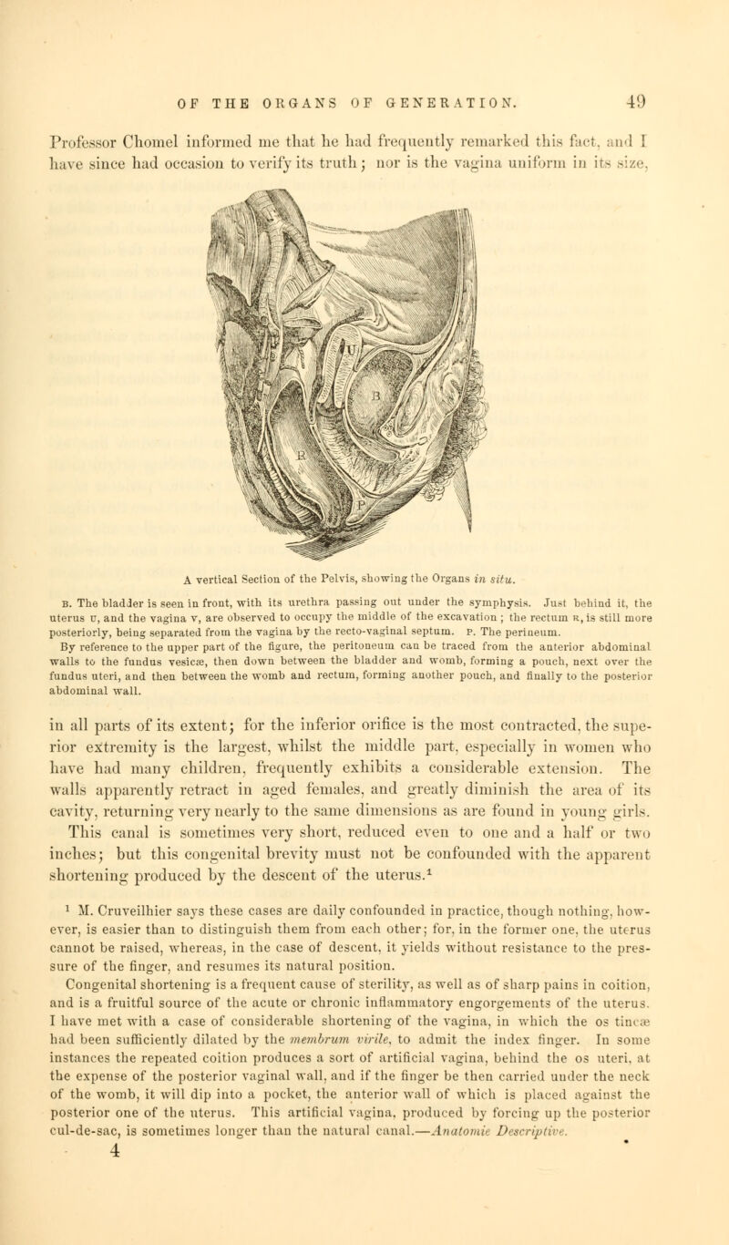 Professor Chomel informed me that lie had frequently remarked this fact, mid I have since had occasion to verify its truth; nor is the vagina uniform in its size, A vertical Section of the Pelvis, showing the Organs in situ. B. The bladder is seen in front, with its urethra passing out under the symphysis. Just behind it, the uterus u, and the vagina v, are observed to occupy the middle of the excavation ; the rectum r, is still more posteriorly, being separated from the vagina by the recto-vaginal septum, p. The perineum. By reference to the upper part of the figure, the peritoneum can be traced from the anterior abdominal walls to the fundus vesicas, then down between the bladder and womb, forming a pouch, next over the fundus uteri, and then between the womb and rectum, forming another pouch, and finally to the posterior abdominal wall. in all parts of its extent; for the inferior orifice is the most contracted, the supe- rior extremity is the largest, whilst the middle part, especially in women who have had many children, frequently exhibits a considerable extension. The walls apparently retract in aged females, and greatly diminish the area of its cavity, returning very nearly to the same dimensions as are found in young girls. This canal is sometimes very short, reduced even to one and a half or two inches; but this congenital brevity must not be confounded with the apparent shortening produced by the descent of the uterus.1 1 M. Cruveilhier says these cases are daily confounded in practice, though nothing, how- ever, is easier than to distinguish them from each other; for, in the former one, the uterus cannot be raised, whereas, in the case of descent, it yields without resistance to the pres- sure of the finger, and resumes its natural position. Congenital shortening is a frequent cause of sterility, as well as of sharp pains in coition, and is a fruitful source of the acute or chronic inflammatory engorgements of the uterus. I have met with a case of considerable shortening of the vagina, in which the os tincae had been sufficiently dilated by the membrum virile, to admit the index finger. In some instances the repeated coition produces a sort of artificial vagina, behind the os uteri. ;\t the expense of the posterior vaginal wall, and if the finger be then carried under the neck of the womb, it will dip into a pocket, the anterior wall of which is placed against the posterior one of the uterus. This artificial vagina, produced by forcing up the posterior cul-de-sac, is sometimes longer than the natural canal.—Anatomic Descriptive.