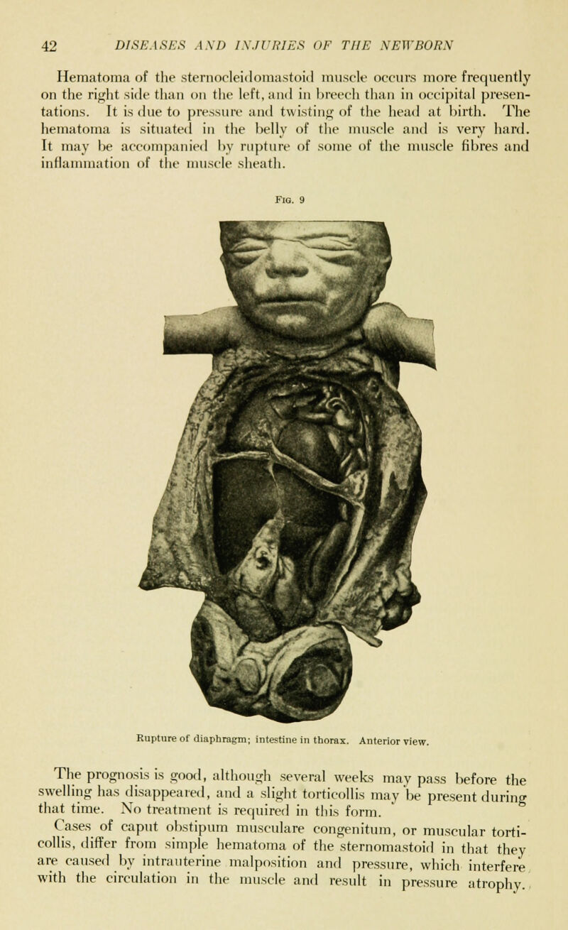 Hematoma of the sternocleidomastoid muscle occurs more frequently on the right side than on the left, and in breech than in occipital presen- tations. It is due to pressure ami twisting of the head at birth. The hematoma is situated in the belly of the muscle and is very hard. It may be accompanied by rupture of some of the muscle fibres and inflammation of the muscle sheath. Fig. 9 Rupture of diaphragm; intestine in thorax. Anterior view. The prognosis is good, although several weeks may pass before the swelling has disappeared, and a slight torticollis may be present during that time. No treatment is required in this form. Cases of caput obstipum musculare congenitum, or muscular torti- collis, differ from simple hematoma of the sternomastoid in that they are caused by intrauterine malposition and pressure, which interfere with the circulation in the muscle and result in pressure atrophy.