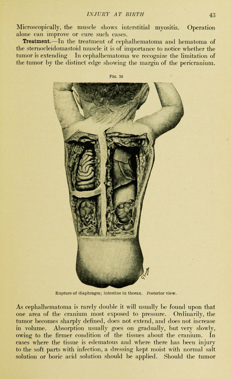 Microscopically, the muscle shows interstitial myositis. Operation alone can improve or cure such cases. Treatment.—In the treatment of cephalhematoma and hematoma of the sternocleidomastoid muscle it is of importance to notice whether the tumor is extending In cephalhematoma we recognize the limitation of the tumor by the distinct edge showing the margin of the pericranium. Fig. 10 Rupture of diaphragm; intestine in thorax. Posterior view. As cephalhematoma is rarely double it will usually be found upon that one area of the cranium most exposed to pressure. Ordinarily, the tumor becomes sharply defined, does not extend, and does not increase in volume. Absorption usually goes on gradually, but very slowly, owing to the firmer condition of the tissues about the cranium. In cases where the tissue is edematous and where there has been injury to the soft parts with infection, a dressing kept moist with normal salt solution or boric acid solution should be applied. Should the tumor