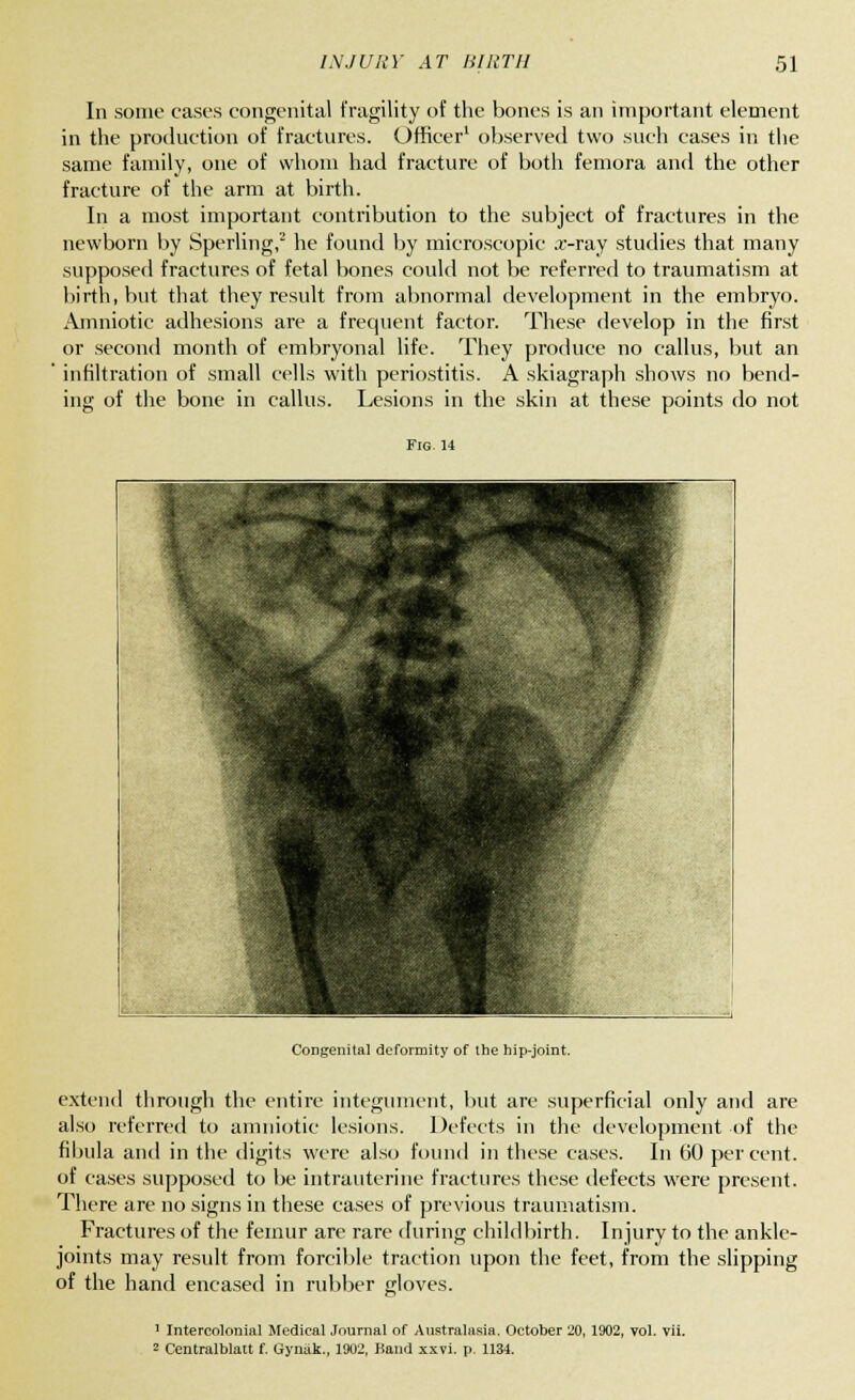 In some cases congenital fragility of the bones is an important element in the production of fractures. Officer1 observed two such cases in the same family, one of whom had fracture of both femora and the other fracture of the arm at birth. In a most important contribution to the subject of fractures in the newborn by Sperling,2 he found by microscopic x-ray studies that many supposed fractures of fetal bones could not be referred to traumatism at birth, but that they result from abnormal development in the embryo. Amniotic adhesions are a frequent factor. These develop in the first or second month of embryonal life. They produce no callus, but an infiltration of small cells with periostitis. A skiagraph shows no bend- ing of the bone in callus. Lesions in the skin at these points do not Fig.14 Congenita] deformity of the hip-joint. extend through the entire integument, but are superficial only and are also referred to amniotic lesions. Defects in the development of the fibula and in the digits were also found in these cases. In 60 percent, of cases supposed to be intrauterine fractures these defects were present. There are no signs in these cases of previous traumatism. Fractures of the femur are rare during childbirth. Injury to the ankle- joints may result from forcible traction upon the feet, from the slipping of the hand encased in rubber gloves. 1 Intercolonial Medical Journal of Australasia. October 20, 1902, vol. vii.