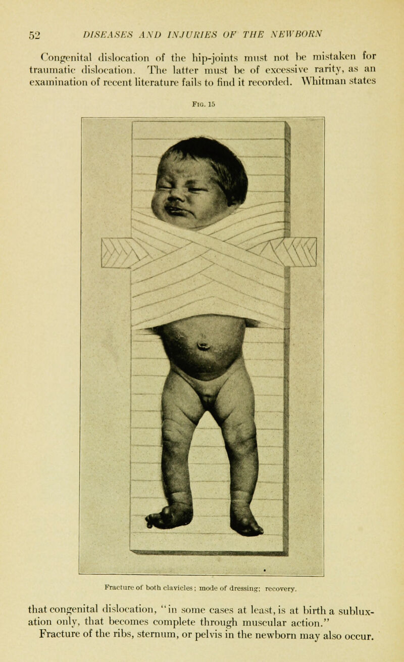 Congenital dislocation of the hip-joints must not be mistaken for traumatic dislocation. The latter must be of excessive rarity, as an examination of recent literature fails to find it recorded. Whitman states Fig. 15 Fracture of both clavicles; mode of dressing; recovery. that congenital dislocation, in some cases at least, is at birth a sublux- ation only, that becomes complete through muscular action. Fracture of the ribs, sternum, or pelvis in the newborn may also occur.