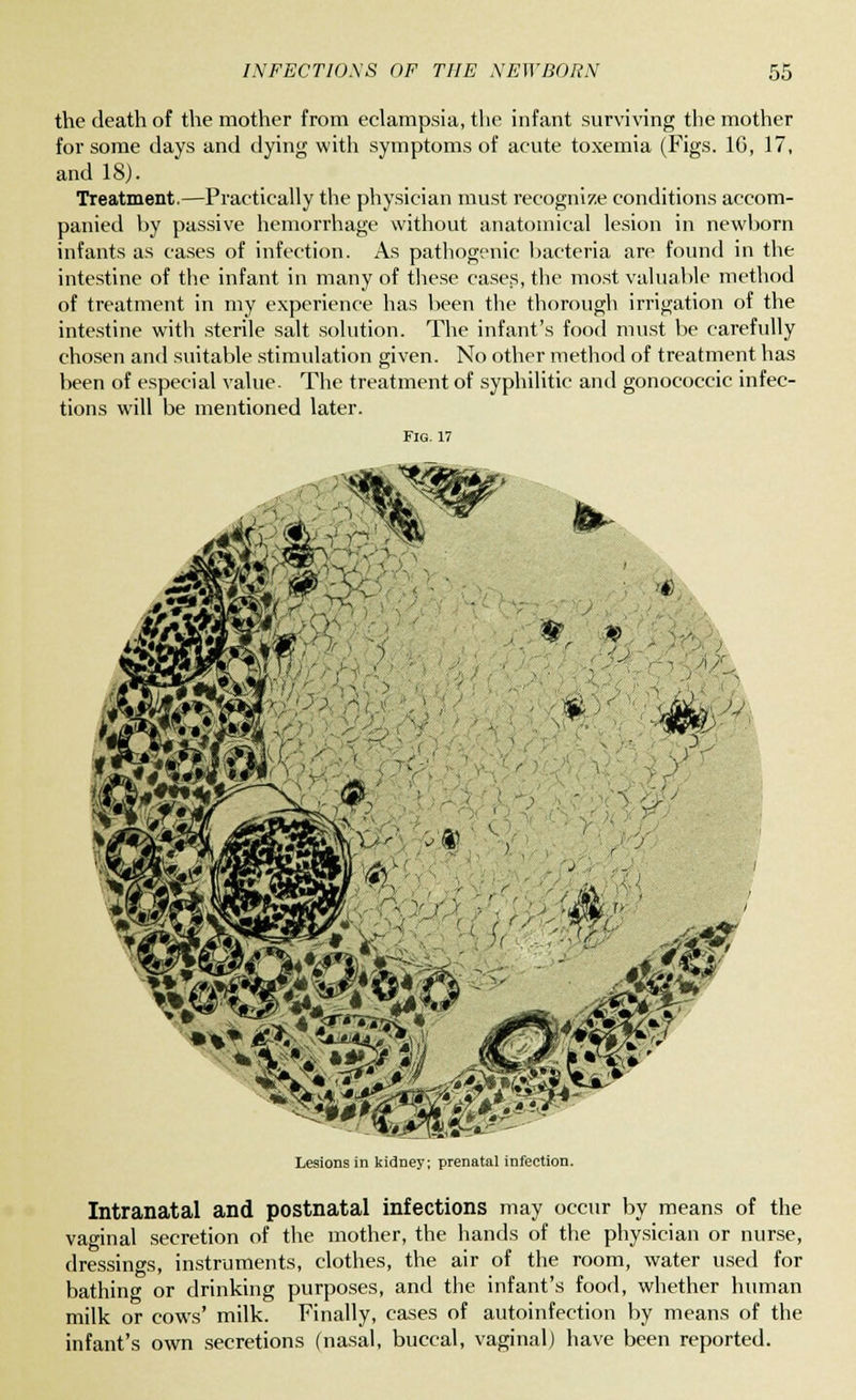 the death of the mother from eclampsia, the infant surviving the mother for some days and dying with symptoms of acute toxemia (Figs. 16, 17, and 18). Treatment.—Practically the physician must recognize conditions accom- panied by passive hemorrhage without anatomical lesion in newborn infants as cases of infection. As pathogenic bacteria are found in the intestine of the infant in many of these cases, the most valuable method of treatment in my experience has been the thorough irrigation of the intestine with sterile salt solution. The infant's food must be carefully chosen and suitable stimulation given. No other method of treatment has been of especial value. The treatment of syphilitic and gonococcic infec- tions will be mentioned later. Fig.17 *- & n> ($P . </■ V 4&& Lesions in kidney; prenatal infection. Intranatal and postnatal infections may occur by means of the vaginal secretion of the mother, the hands of the physician or nurse, dressings, instruments, clothes, the air of the room, water used for bathing or drinking purposes, and the infant's food, whether human milk or cows' milk. Finally, cases of autoinfection by means of the infant's own secretions (nasal, buccal, vaginal) have been reported.