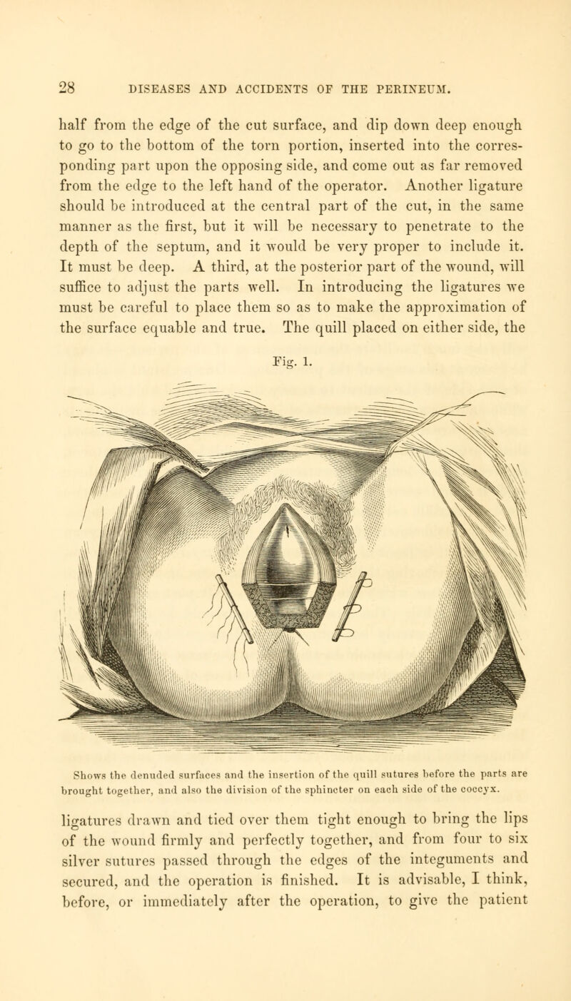 half from the edge of the cut surface, and dip down deep enough to go to the bottom of the torn portion, inserted into the corres- ponding part upon the opposing side, and come out as far removed from the edge to the left hand of the operator. Another ligature should be introduced at the central part of the cut, in the same manner as the first, but it will be necessary to penetrate to the depth of the septum, and it would be very proper to include it. It must be deep. A third, at the posterior part of the wound, will suffice to adjust the parts well. In introducing the ligatures we must be careful to place them so as to make the approximation of the surface equable and true. The quill placed on either side, the Fie. 1. Shows the denuded surfaces and the insertion of the quill sutures hefore the parts are brought together, and also the division of the sphincter on each side of the coccyx. ligatures drawn and tied over them tight enough to bring the lips of the wound firmly and perfectly together, and from four to six silver sutures passed through the edges of the integuments and secured, and the operation is finished. It is advisable, I think, before, or immediately after the operation, to give the patient