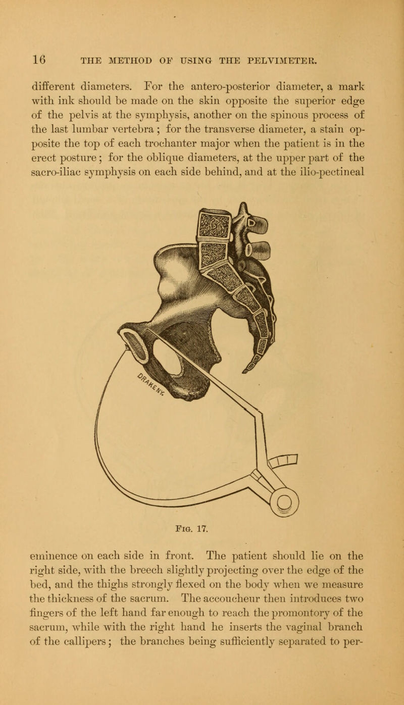 different diameters. For the anteroposterior diameter, a mark with ink should be made on the skin opposite the superior edge of the pelvis at the symphysis, another on the spinous process of the last lumbar vertebra ; for the transverse diameter, a stain op- posite the top of each trochanter major when the patient is in the erect posture ; for the oblique diameters, at the upper part of the sacro-iliac symphysis on each side behind, and at the ilio-pectineal Fig. 17. eminence on each side in front. The patient should lie on the right side, with the breech slightly projecting over the edge of the bed, and the thighs strongly Hexed on the body when Ave measure the thickness of the sacrum. The accoucheur then introduces two fingers of the left hand far enough to reach the promontory of the sacrum, while with the right hand he inserts the vaginal branch of the callipers; the branches being sufficiently separated to per-