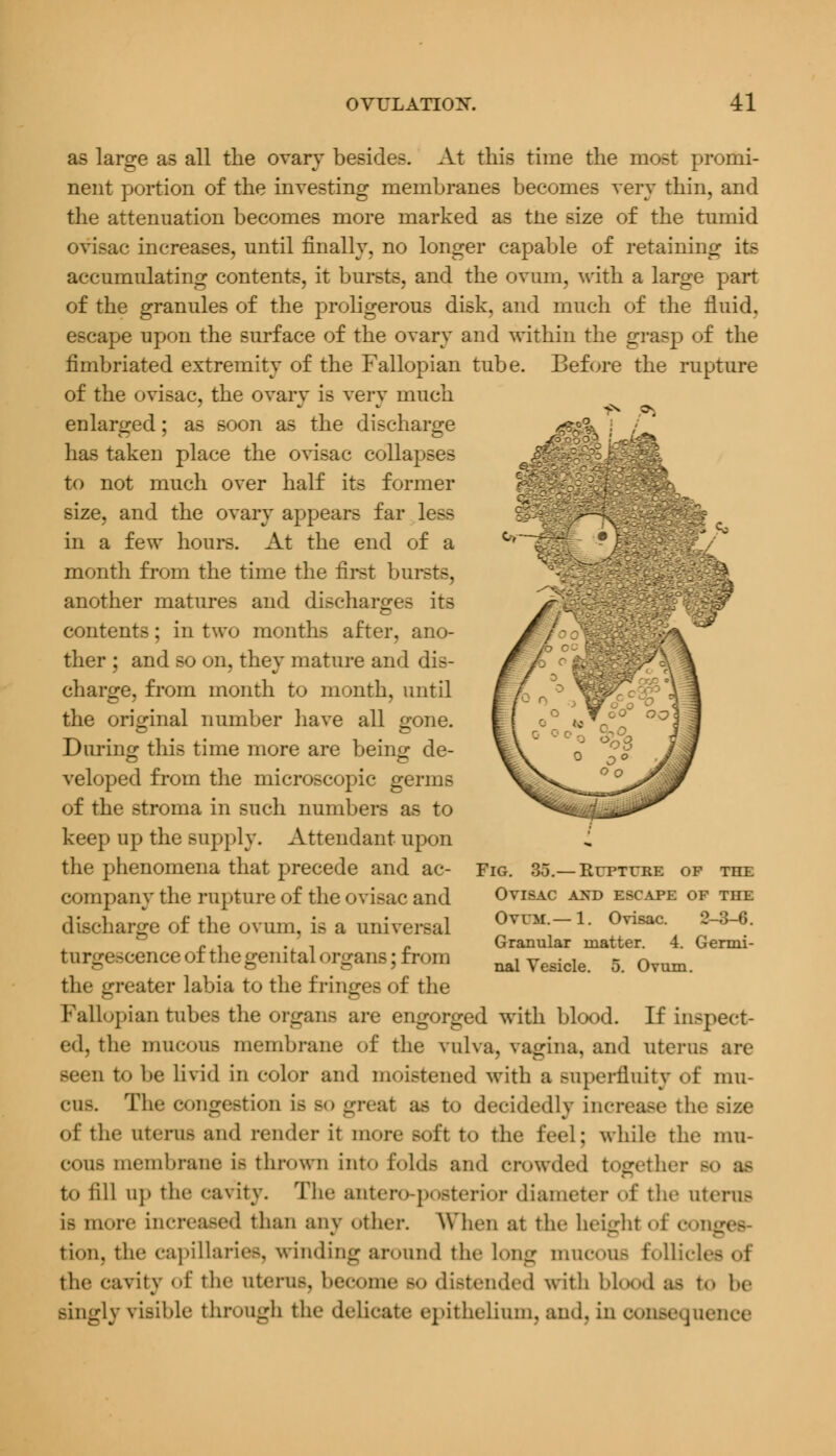 -x 9* as large as all the ovary besides. At this time the most promi- nent portion of the investing membranes becomes very thin, and the attenuation becomes more marked as tne size of the tumid ovisac increases, until finally, no longer capable of retaining its accumulating contents, it bursts, and the ovum, with a large part of the granules of the proligerous disk, and much of the fluid. escape upon the surface of the ovary and within the grasp of the fimbriated extremity of the Fallopian tube. Before the rupture of the ovisac, the ovary is very much enlarged; as soon as the discharge has taken place the ovisac collapses to not much over half its former size, and the ovary appears far las in a few hours. At the end of a month from the time the first burets, another matures and discharges its contents; in two months after, ano- ther ; and so on, they mature and dis- charge, from month to month, until the original number have all £one. During this time more are being de- veloped from the microscopic genus of the stroma in such numbers as to keep up the supply. Attendant upon the phenomena that precede and ac- company the rupture of the ovisac and discharge of the ovum, is a universal t urirescence of the genital organs; £m >m the greater labia to the fringes of the Fallopian tubes the organs are engorged with blood. If inspect- ed, the mucous membrane of the vulva, vagina, and uterus are d to be livid in color and moistened with a superfluity of mu- cus. The congestion is so great as to decidedly increase the size of the nterofl and render it more soft to the feel; while the mu- cous membrane is thrown into folds and crowded together bo m to fill up the cavity. The antero-posterior diameter of the uterus is more increased than any other. When at the height of el., tion. the capillaries, winding around the long muCOUfl follicles of the cavity of the uterus, become so distended with blood as to be singly visible through the delicate epithelium, and. in consequence Fig. 35.—Rupture op the Ovisac and escape of tiie Ovum.—1. Ovisac. 2-3-6. Granular matter. 4. Germi- nal Vesicle. 5. Ovum.