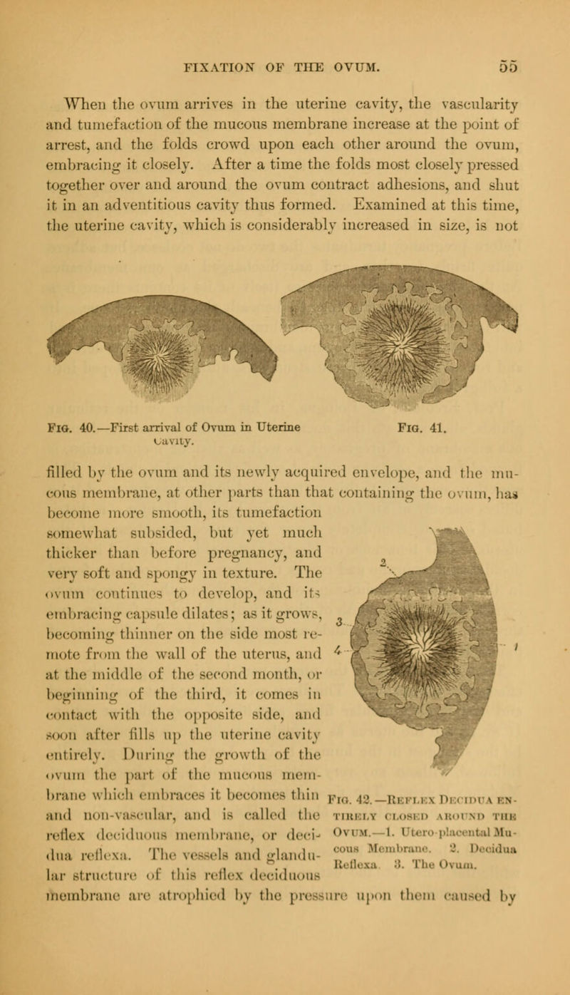 When the ovum arrives in the uterine cavity, the vascularity and tumefaction of the mucous membrane increase at the point of arrest, and the folds crowd upon each other around the ovum, embracing it closely. After a time the folds most closely pressed together over and around the ovum contract adhesions, and shut it in an adventitious cavity thus formed. Examined at this time, the uterine cavity, which is considerably increased in size, is not FlO. 40. —First arrival of Ovum in Uterine euviiy. Fig. 41. filled by the ovum and it> newly acquired envelope, and the mu- cous membrane, at other parts than that containing the ovum,has become more smooth, il> tumefaction somewhat subsided, but yet much thicker than before pregnancy, and very soft and Bpongy in texture. The ovum continues to develop, and it> embracing capsule dilate-; a- it grows, becoming thinner on the side most re mote from the Wall of the uterus, and at the middle of the second month, or beginning of the third, it comes in contact with the opposite side, and soon after till- up the uterine cavity ' c; entirely. During the growth of tin- ,-._ «»\ urn the part of the mUCOUfl mem brane which embrace- it becomes thin Fl,; 43 _]u , , , t pj x , N and aon-vascular, and is called the thusli closed ground phi reflex deciduous membrane, or deci- ,K,M I. Uteropiaoeni dua reflexa. The vessels and gland u- ?J MomQb™ ' ****** ,.,,., I !- Ovum. lar structure I tins reflex deciduous membrane are atrophied by the pressure upon them caused by