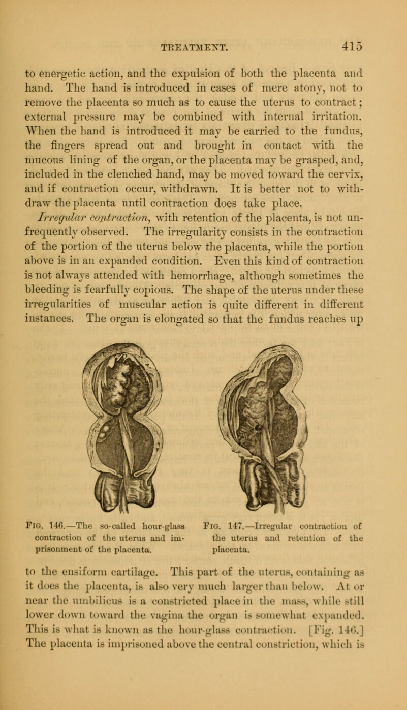 to energetic action, and the expulsion of both the placenta and hand. The hand is introduced incases of mere atony, not to remove the placenta so much as to cause the uterus to contract; external pressure may be combined with internal irritation. When the hand is introduced it may be carried to the fundus, the fingers spread out and brought in contact with the mucous lining of the organ, or the placenta may be grasped, and, included in the clenched hand, may be moved toward the cervix, and if contraction occur, withdrawn. It is better not to with- draw the placenta until contraction does take place. Irregular co&trtiction, with retention of the placenta, is not un- frequently observed. The irregularity consists in the contraction of the portion of the uterus below the placenta, while the portion above is in an expanded condition. Even this kind of contraction is not alwavs attended with hemorrhage, although sometimes the bleeding is fearfully copious. The shape of the uterus under these irregularities of muscular action is quite different in different instances. The organ is elongated so that the fundus reaches up PlG. 14G.—The so-called hour-glass Fig. 147.—Irregular contraction o£ contraction of the uterus and im- the uterus and retention of the prisonment of the placenta. placenta. to the ensiform cartilage. Thia part of the uterus, containing it does the placenta, La also very much Larger than below. A.tor near the umbilicus is a constricted place in the mass, while still Lower down toward the vagina the organ is somewhat expanded. This is what la known us the hour-glass contraction, j Fig. l 16, The placenta ie imprisoned above the central constriction, which is