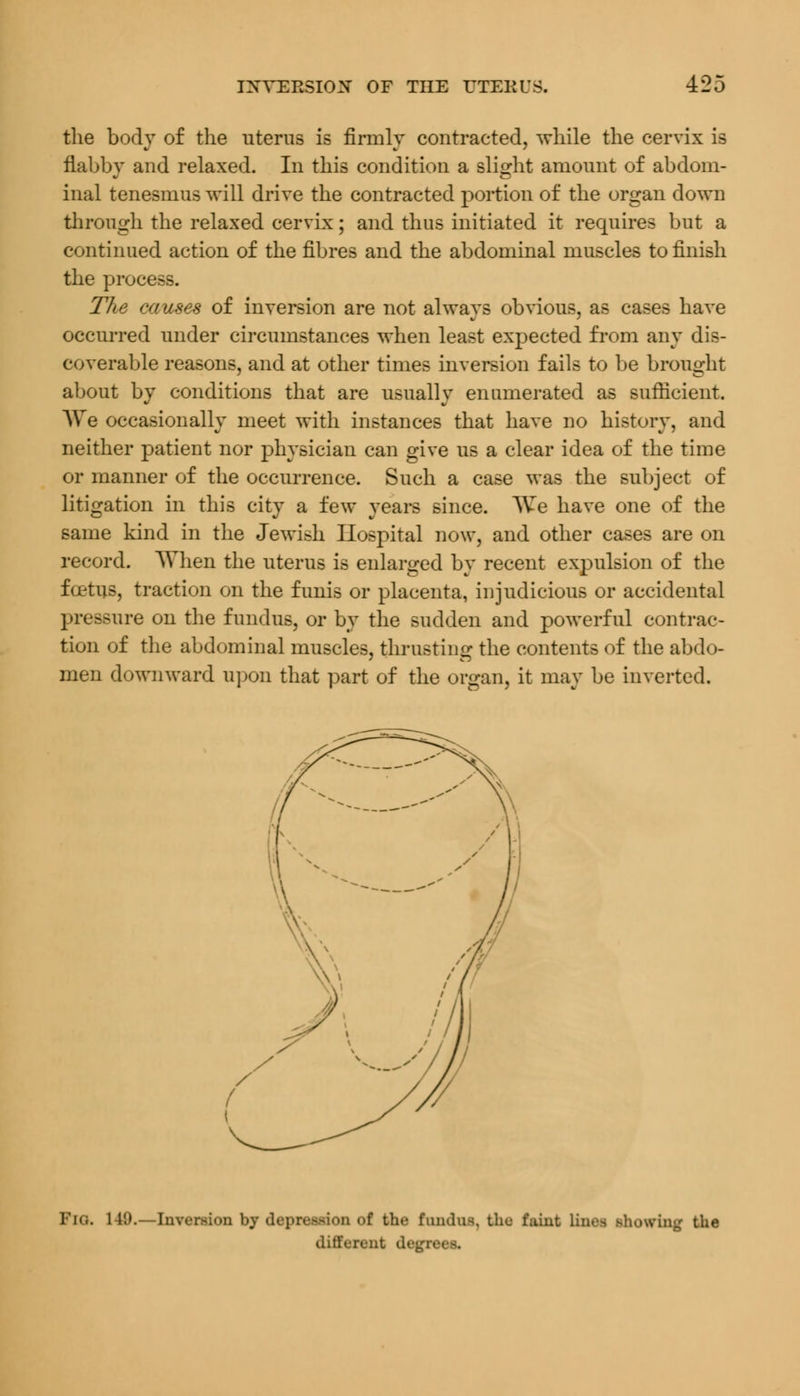 the body of the uterus is firmly contracted, while the cervix is flabby and relaxed. In this condition a slight amount of abdom- inal tenesmus will drive the contracted portion of the organ down through the relaxed cervix; and thus initiated it requires but a continued action of the fibres and the abdominal muscles to finish the process. The causes of inversion are not always obvious, as cases have occurred under circumstances when least expected from any dis- coverable reasons, and at other times inversion fails to be brought about by conditions that are usually enumerated as sufficient. Ave occasionally meet with instances that have no history, and neither patient nor physician can give us a clear idea of the time or manner of the occurrence. Such a case was the subject of litigation in this city a few years since. AVe have one of the same kind in the Jewish Hospital now, and other cases are on record. When the uterus is enlarged by recent expulsion of the foetus, traction on the funis or placenta, injudicious or accidental pressure on the fundus, or by the sudden and powerful contrac- tion of the abdominal muscles, thrusting the contents of the abdo- men downward upon that part of the organ, it may be inverted. Fig. 149.—Inversion by depression of the fundus, the faint lims showing the different decrees.