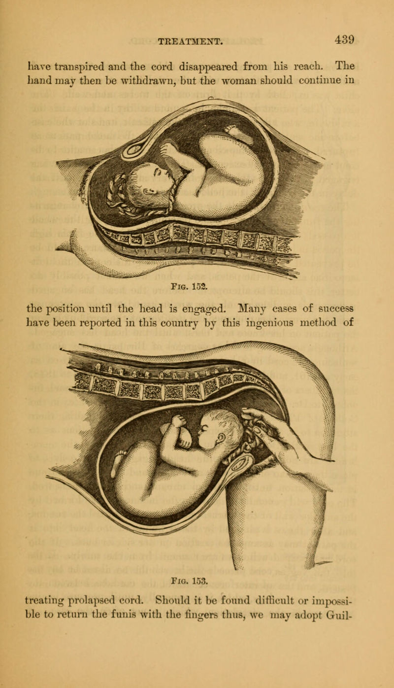 have transpired and the cord disappeared from his reach. The hand may then be withdrawn, but the woman should continue in Fig. 152. the position until the head is engaged. Many cases of success have been reported in this country by this ingenious method of Pick 158. treating prolapsed cord Should it be found difficult or impossi- ble to return the funis with the linger thus, we may adopt (iuil-