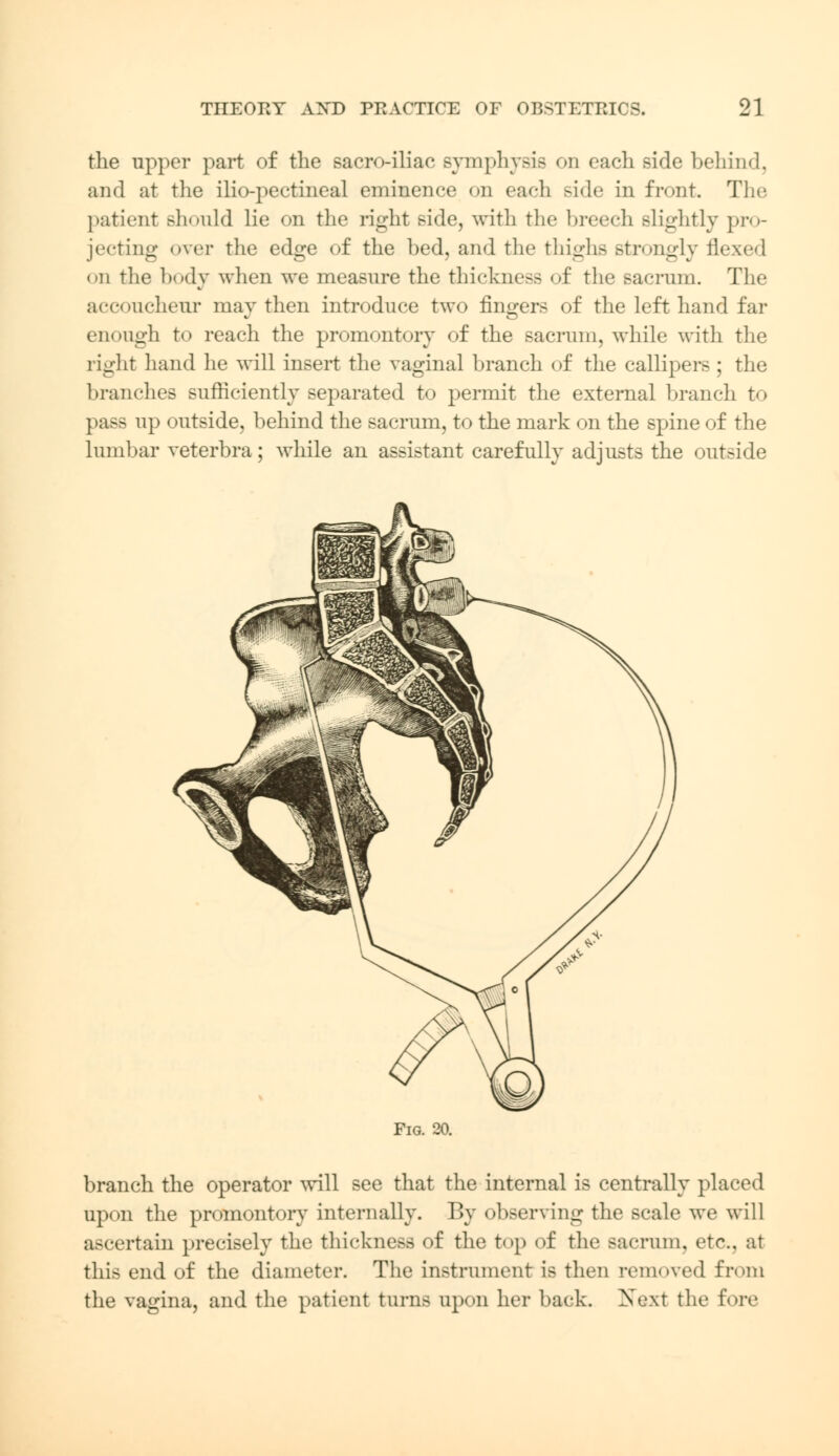 the upper part of the sacroiliac symphysis on each side behind, and at the ilio-pectineal eminence on each side in front The patient Bhonld lie on the right side, with the breech slightly pro- jecting over the edge of the bed, and the thighs strongly flexed on the body when we measure the thickness of the sacrum. The accoucheur may then introduce two fingers of the left hand far enough to reach the promontory of the sacrum, while with the right hand he will insert the vaginal branch of the callipers ; the branches sufficiently separated to permit the external branch to pass up outside, behind the sacrum, to the mark on the spine of the lumbar veterbra; while an assistant carefully adjusts the outside Pig. 20. branch the operator will see that the internal is centrally placed upon the promontory internally. By observing the scale we will ascertain precisely the thickness of the top of the sacrum, etc. at this end of the diameter. The instrument is then removed from the vagina, and the patient tarns apon her back. Next the fore