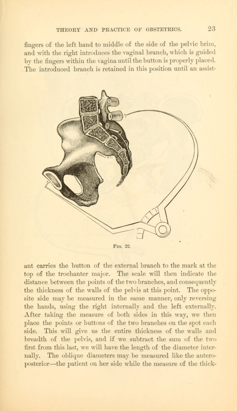 fingers of the left hand to middle of the side of the pelvic brim, and with the right introduces the vaginal branch, which is guided by the fingers within the: vagina until the button is properly placed. Tliu introduced branch is retained in this position until an Fig. 22. ant carries the button of the external branch to the mark at the top of the trochanter major. The scale will then indicate the distance between the points of the two branches, and consequently the thickness of the walls of the pelvis at this point. The oppo- site side may be measured in the same manner, only reversing the hands, using the right internally and the left externally. After taking the measure of both sides in this way, we then place the points or buttons of the two branches on the spot each side. This will give us the entire thickness of the walls and breadth of the pelvis, and if we subtract the sum of the two first from this last, we will have the length of the diameter inter- nally. The oblique diameters may be measured like the antero- posterior—the patient on her side while the measure of the thick-
