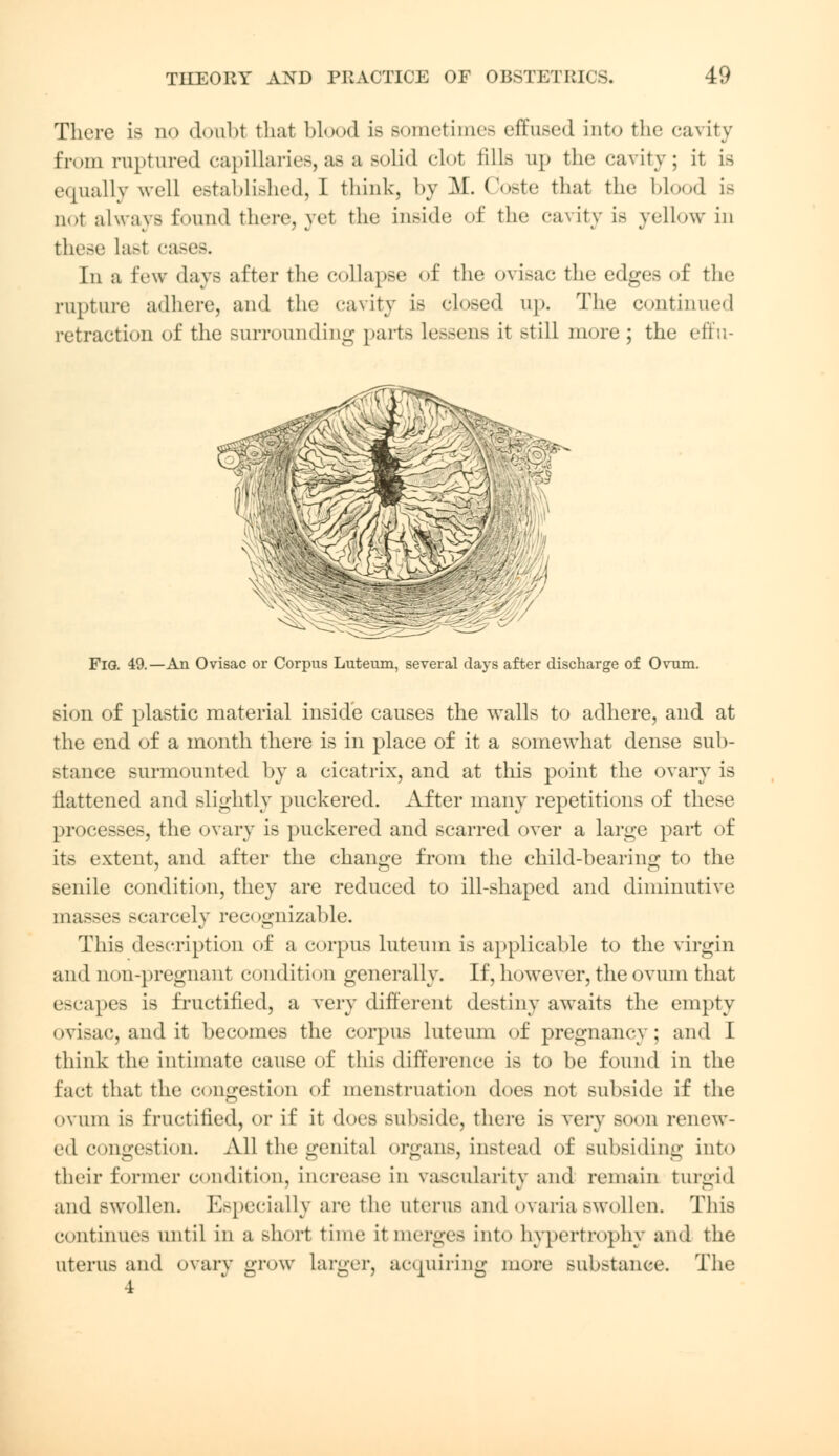 There is no doubt that blood is Bometimes effused into the cavity from nip tared capillaries, as a solid clot tills up the cavity; it is equally well established, 1 think, by M. Coste that the Mood is not always found there, yet the inside of tin; cavity is yellow in these Lasl cases. In a Eew <lays after the collapse of the ovisac the edges of the rupture adhere, and the cavity is closed up. The continued retraction of the surrounding parts lessens it still more ; the effn- FlG. 49.—An Ovisac or Corpus Luteum, several days after discharge of Ovum. sion of plastic material inside causes the walls to adhere, and at the end of a month there is in place of it a somewhat dense sub- stance surmounted by a cicatrix, and at this point the ovary is flattened and slightly puckered. After many repetitions of these processes, the ovary is puckered and scarred over a large part of its extent, and after the change from the child-hearing to the senile condition, they are reduced to ill-shaped and diminutive masses scarcely recognizable. This description of a corpus luteum is applicable to the virgin and non-pregnant condition generally. If, however, the ovum that escapes is fructified, a very different destiny awaits the empty ovisac, and it becomes the corpus luteum of pregnancy; and I think the intimate cause of this difference is to be found in the fact that the congestion of menstruation does not subside if the ovum is fructified, or if it does subside, there is very soon renew- ed congestion. All the genital organs, instead of subsiding into their former condition, increase in vascularity and remain turgid and swollen. Especially are the uterus and ovaria swollen. This continues until in a short time it merges into hypertrophy and the uterus and ovary grow larger, acquiring more substance. The 4