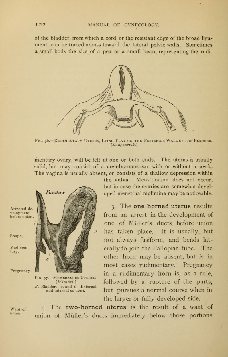 of the bladder, from which a cord, or the resistant edge of the broad liga- ment, can be traced across toward the lateral pelvic walls. Sometimes a small body the size of a pea or a small bean, representing the rudi- Fig. 96.—Rudimentary Uterus, Lying Flat on the Posterior Wall of the Bladder. {Langenbeck.) Shape. Rudimen- tary. Pregnancy Want of union. mentary ovary, will be felt at one or both ends. The uterus is usually solid, but may consist of a membranous sac with or without a neck. The vagina is usually absent, or consists of a shallow depression within the vulva. Menstruation does not occur, but in case the ovaries are somewhat devel- -Fundus Xa SaSl oped menstrual molimina may be noticeable. 3. The one-horned uterus results from an arrest in the development of one of Miiller's ducts before union has taken place. It is usually, but not always, fusiform, and bends lat- erally to join the Fallopian tube. The other horn may be absent, but is in most cases rudimentary. Pregnancy in a rudimentary horn is, as a rule, followed by a rupture of the parts, but pursues a normal course when in the larger or fully developed side. 4. The two-horned uterus is the result of a want of union of Miiller's ducts immediately below those portions Fig. 97.—Membranous Uterus. (IVinckel.) B. Bladder, e. and i. External and internal os uteri.