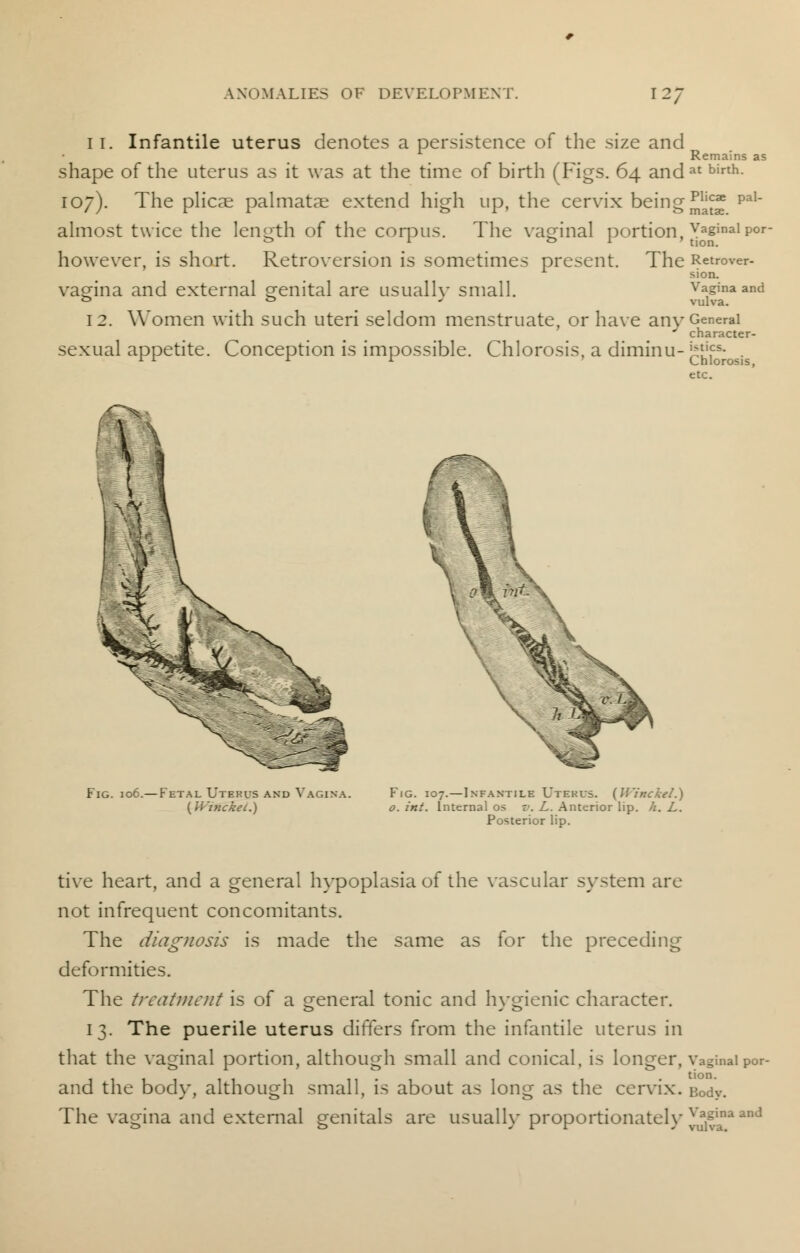 11. Infantile uterus denotes a persistence of the size and shape of the uterus as it was at the time of birth (Figs. 64 and 107). The plicae palmatre extend high up, the cervix being almost twice the length of the corpus. The vaginal portion, however, is short. Retroversion is sometimes present. The vagina and external genital are usually small. 12. Women with such uteri seldom menstruate, or have any sexual appetite. Conception is impossible. Chlorosis, a diminu- Remains as at birth. Plicae pal- matse. Vaginal por- tion. Retrover- sion. Vagina and vulva. General character- istics. Chlorosis, etc. Fig. jo6. Fetal Utekus and Vagi: (Winckei.) Fig. 107.—Infantile Utekus. {Winckei.} o. int. Internal os v. L. Anterior lip. //. L. Posterior lip. tive heart, and a general hypoplasia of the vascular system arc not infrequent concomitants. The diagnosis is made the same as for the preceding deformities. The treatment is of a general tonic and hygienic character. 13. The puerile uterus differs from the infantile uterus in that the vaginal portion, although small and conical, is longer, Vaginal Por- and the body, although small, is about as long as the cervix. Body. The vagina and external genitals are usually proportionately ^4* and