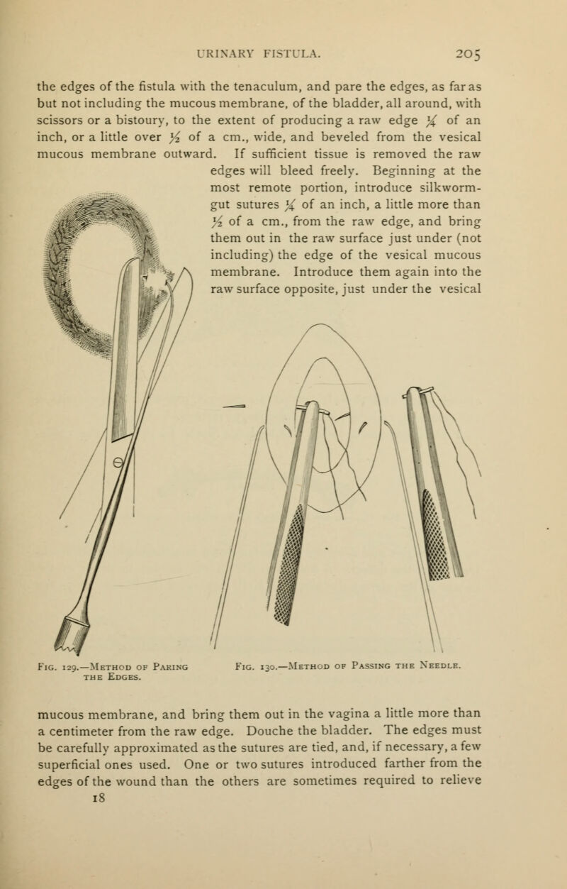 the edges of the fistula with the tenaculum, and pare the edges, as far as but not including the mucous membrane, of the bladder, all around, with scissors or a bistoury, to the extent of producing a raw edge % of an inch, or a little over y2 of a cm., wide, and beveled from the vesical mucous membrane outward. If sufficient tissue is removed the raw edges will bleed freely. Beginning at the most remote portion, introduce silkworm- gut sutures % of an inch, a little more than Vz of a cm., from the raw edge, and bring them out in the raw surface just under (not including) the edge of the vesical mucous membrane. Introduce them again into the raw surface opposite, just under the vesical Fig. 29.—Method of Paring the Edges. .—Method of Passing the Needle. mucous membrane, and bring them out in the vagina a little more than a centimeter from the raw edge. Douche the bladder. The edges must be carefully approximated as the sutures are tied, and, if necessary, a few superficial ones used. One or two sutures introduced farther from the edges of the wound than the others are sometimes required to relieve