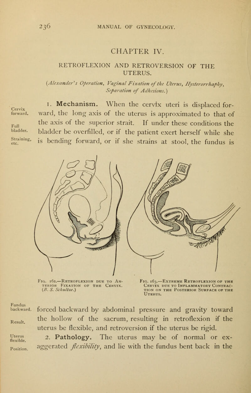 CHAPTER IV. Cervix forward. Full bladder. Strainin| etc. RETROFLEXION AND RETROVERSION OF THE UTERUS. {Alexander's Operation, Vaginal Fixation of the Uterus, Hysterorrhaphy, Separation of Adhesions.') I. Mechanism. When the cervix uteri is displaced for- ward, the long axis of the uterus is approximated to that of the axis of the superior strait. If under these conditions the bladder be overfilled, or if the patient exert herself while she is bending forward, or if she strains at stool, the fundus is Fie;. 162.—Retroflexion due to An- terior Fixation of the Cervix. (B. S. Schultze.) Fig. 163.—Extreme Retroflexion of the Cervix due to Inflammatory Contrac- tion on the Posterior Surface of the Uterus. Fundus backward. Result. Uterus flexible. Position. forced backward by abdominal pressure and gravity toward the hollow of the sacrum, resulting in retroflexion if the uterus be flexible, and retroversion if the uterus be rigid. 2. Pathology. The uterus may be of normal or ex- aggerated flexibility, and lie with the fundus bent back in the