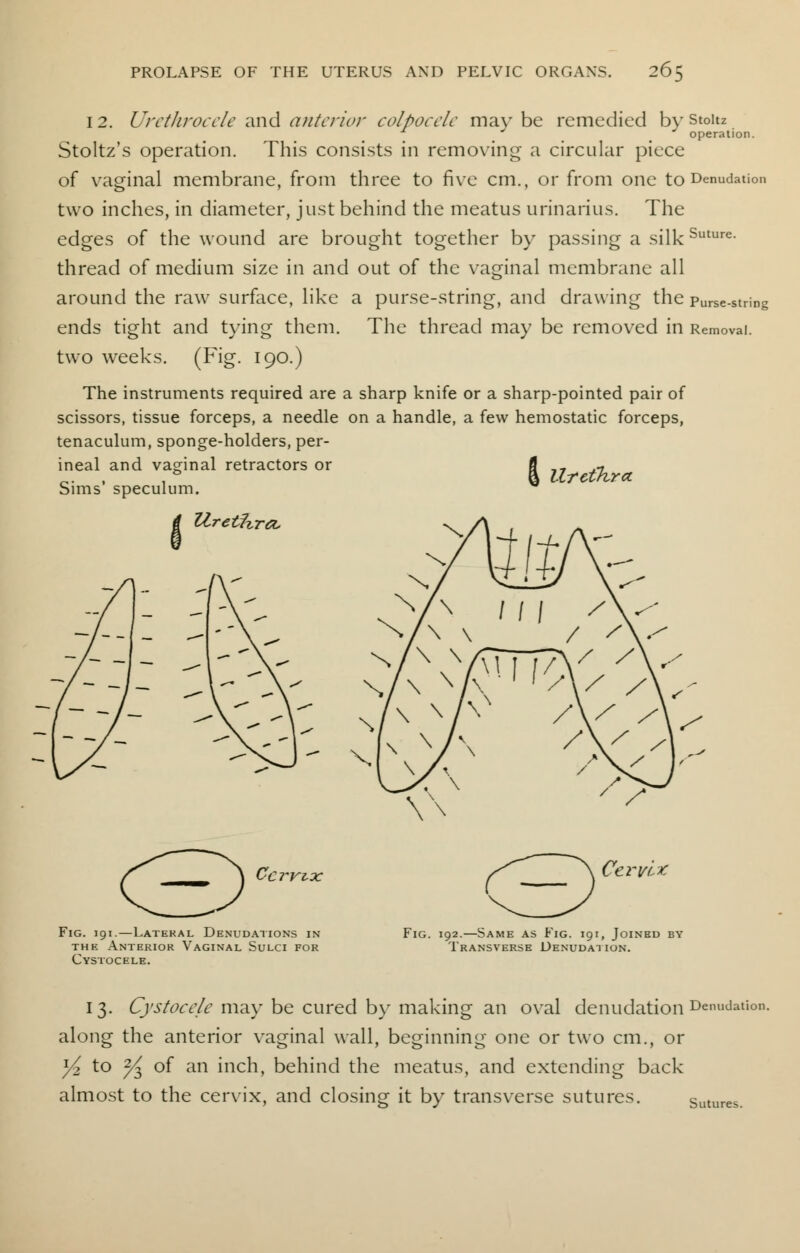 26 12. Urethrocele and anterior colpocele may be remedied by stoitz operation. Stoltz's operation. This consists in removing a circular piece of vaginal membrane, from three to five cm., or from one to Denudation two inches, in diameter, just behind the meatus urinarius. The edges of the wound are brought together by passing a silk Suture- thread of medium size in and out of the vaginal membrane all around the raw surface, like a purse-string, and drawing the purse-string ends tight and tying them. The thread may be removed in Removal, two weeks. (Fig. 190.) The instruments required are a sharp knife or a sharp-pointed pair of scissors, tissue forceps, a needle on a handle, a few hemostatic forceps, tenaculum, sponge-holders, per- ineal and vaginal retractors or fl 7 ^ Sims' speculum. Urethra, Fig. 191.—Lateral Denudations in the Anterior Vaginal Sulci for Cystocele. Cervix, Fig. 192.—Same as Fig. 191, Joined by Transverse Denudation. 13. Cystocele may be cured by making an oval denudation Denudation- along the anterior vaginal wall, beginning one or two cm., or y2 to y^ of an inch, behind the meatus, and extending back almost to the cervix, and closing it by transverse sutures. Sutures.
