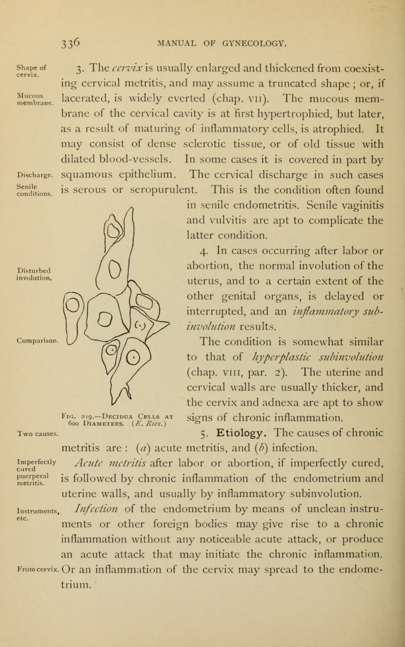 Shape of cervix. Mucous membrane Senile conditions. 3. The cervix \s usually enlarged and thickened from coexist- ing cervical metritis, and may assume a truncated shape ; or, if lacerated, is widely everted (chap. vn). The mucous mem- brane of the cervical cavity is at first hypertrophied, but later, as a result of maturing of inflammatory cells, is atrophied. It may consist of dense sclerotic tissue, or of old tissue with dilated blood-vessels. In some cases it is covered in part by Discharge, squamous epithelium. The cervical discharge in such cases is serous or seropurulent. This is the condition often found in senile endometritis. Senile vaginitis and vulvitis are apt to complicate the latter condition. 4. In cases occurring after labor or abortion, the normal involution of the uterus, and to a certain extent of the other genital organs, is delayed or interrupted, and an inflammatory sub- involution results. The condition is somewhat similar to that of hyperplastic subinvolution (chap, viii, par. 2). The uterine and cervical walls are usually thicker, and the cervix and adnexa are apt to show signs of chronic inflammation. 5. Etiology. The causes of chronic metritis are : (a) acute metritis, and (b) infection. Acute metritis after labor or abortion, if imperfectly cured, is followed by chronic inflammation of the endometrium and uterine walls, and usually by inflammatory subinvolution. Infection of the endometrium by means of unclean instru- ments or other foreign bodies may give rise to a chronic inflammation without any noticeable acute attack, or produce an acute attack that may initiate the chronic inflammation. Or an inflammation of the cervix may spread to the endome- trium. Disturbed involution. Comparison ig. 219.—Decidua Cells at 600 Diameters. (E. Ries.) Two causes Imperfectly cured puerperal metritis. Instruments, etc. From cervix,