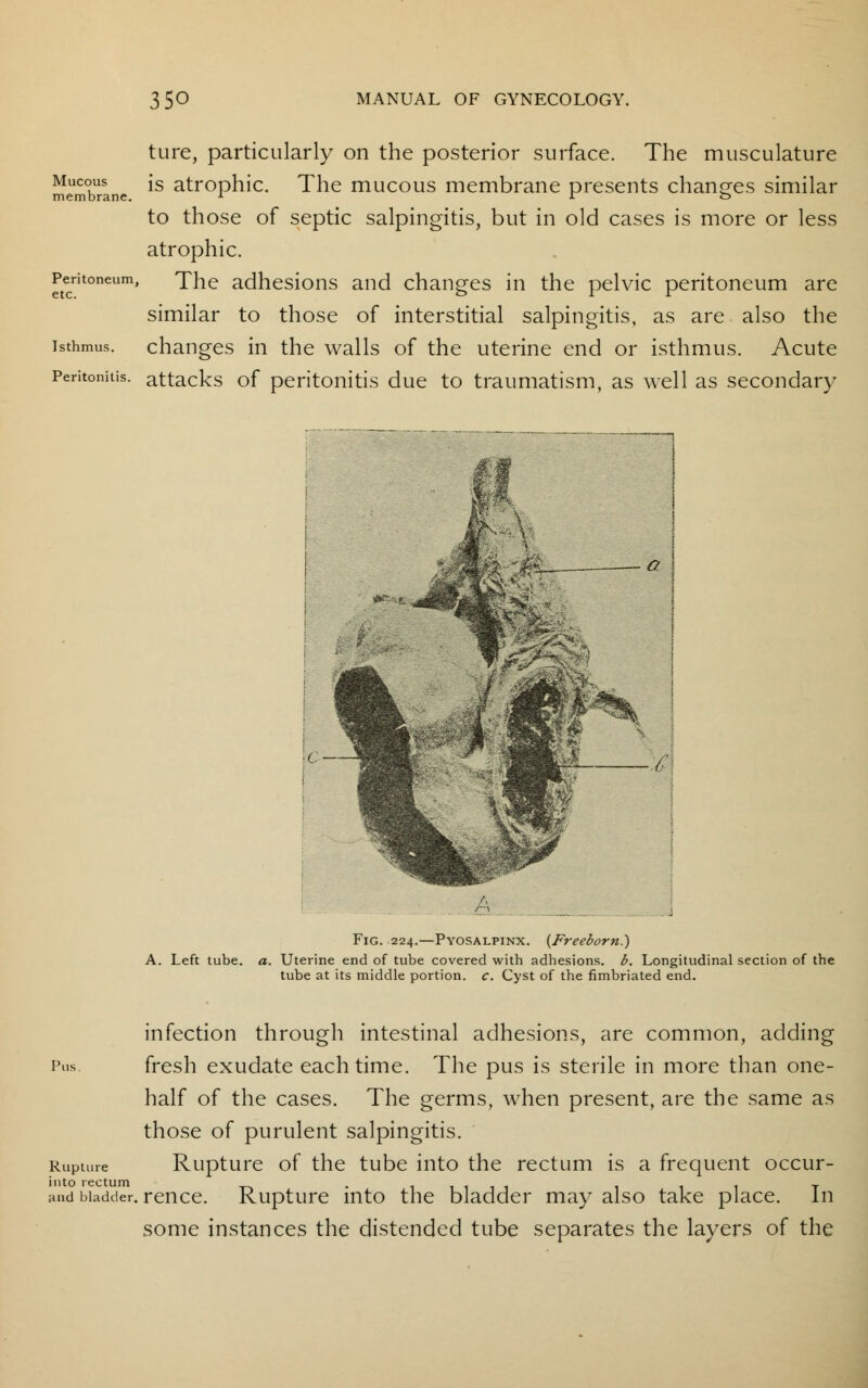 Mucous membrane. Peritoneum etc. Isthmus. Peritonitis. ture, particularly on the posterior surface. The musculature is atrophic. The mucous membrane presents changes similar to those of septic salpingitis, but in old cases is more or less atrophic. The adhesions and changes in the pelvic peritoneum are similar to those of interstitial salpingitis, as are also the changes in the walls of the uterine end or isthmus. Acute attacks of peritonitis due to traumatism, as well as secondary Fig. 224.—Pyosalpinx. {Freeborn.) A. Left tube. a. Uterine end of tube covered with adhesions, b. Longitudinal section of the tube at its middle portion, c. Cyst of the fimbriated end. infection through intestinal adhesions, are common, adding Pus. fresh exudate each time. The pus is sterile in more than one- half of the cases. The germs, when present, are the same as those of purulent salpingitis. Rupture Rupture of the tube into the rectum is a frequent occur- into rectum . 11111 1 11 t aud bladder, rence. Rupture into the bladder may also take place. In some instances the distended tube separates the layers of the