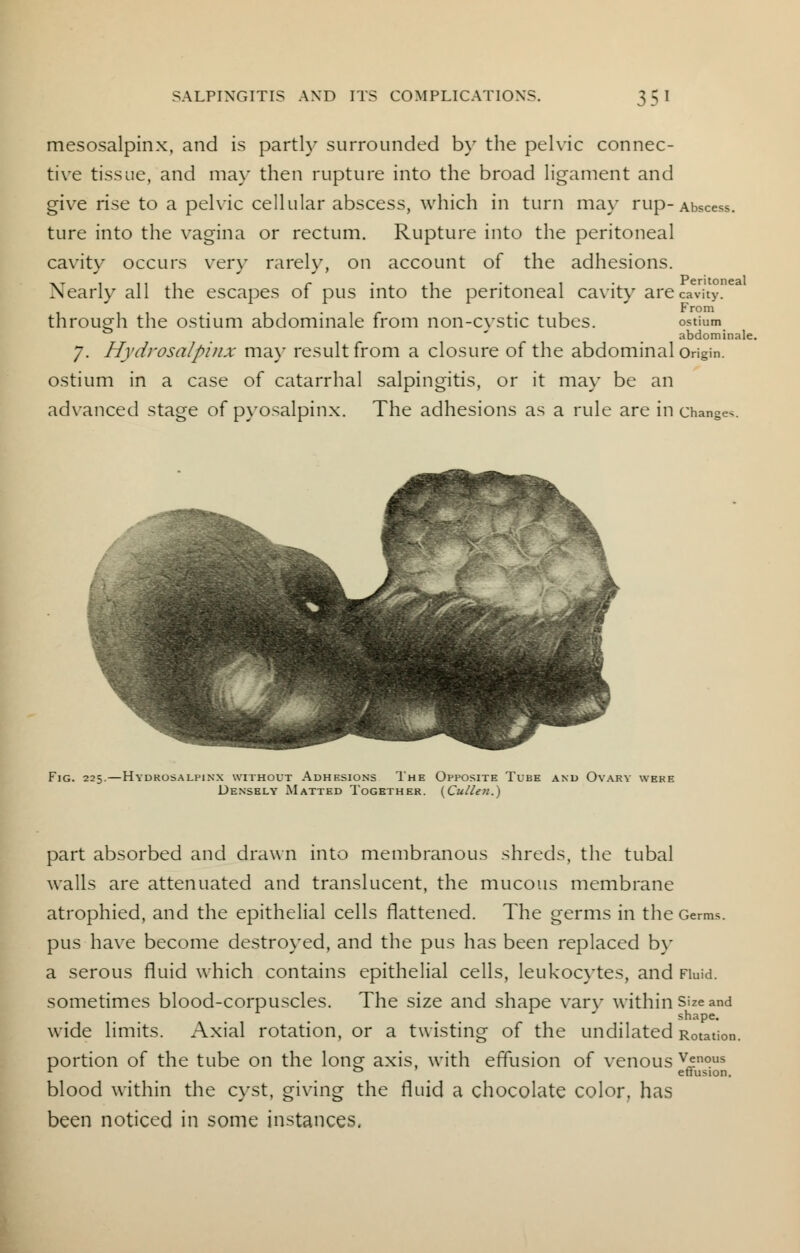 mesosalpinx, and is partly surrounded by the pelvic connec- tive tissue, and may then rupture into the broad ligament and give rise to a pelvic cellular abscess, which in turn may rup- Abscess, ture into the vagina or rectum. Rupture into the peritoneal cavity occurs very rarely, on account of the adhesions. Nearly all the escapes of pus into the peritoneal cavity are cavity. through the ostium abdominale from non-cvstic tubes. ostium ' abdominale. 7. Hydrosalpinx ma}- result from a closure of the abdominal Origin, ostium in a case of catarrhal salpingitis, or it may be an advanced stage of pyosalpinx. The adhesions as a rule are in changes. Fig. 225.—Hydrosalpinx without Adhesions The Opposite Tube and Ovary were Densely Matted Together. {Cullen.) part absorbed and drawn into membranous shreds, the tubal walls are attenuated and translucent, the mucous membrane atrophied, and the epithelial cells flattened. The germs in the Germs, pus have become destroyed, and the pus has been replaced by a serous fluid which contains epithelial cells, leukocytes, and Fluid, sometimes blood-corpuscles. The size and shape van- within size and wide limits. Axial rotation, or a twisting of the undilated Rotation portion of the tube on the long axis, with effusion of venous Venous r ° effusion. blood within the cyst, giving the fluid a chocolate color, has been noticed in some instances.