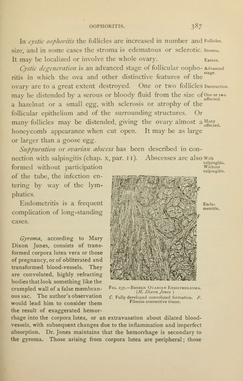 In cystic oophoritis the follicles are increased in number and Follicles. size, and in some cases the stroma is edematous or sclerotic, stroma. It may be localized or involve the whole ovary. Extent. Cystic degeneration is an advanced stage of follicular oopho-Advanced ritis in which the ova and other distinctive features of the ovary are to a great extent destroyed. One or two follicles Destruction, mav be distended bv a serous or bloodv fluid from the size ofoneonwo J affected. a hazelnut or a small egg, with sclerosis or atrophy of the follicular epithelium and of the surrounding structures. Or many follicles may be distended, giving the ovary almost a^yd honeycomb appearance when cut open. It may be as large or larger than a goose egg. Suppuration or ovarian abscess has been described in con- nection with salpingitis (chap. x. par. 11). Abscesses are also with ^ & X / r salpingitis. formed without participation of the tube, the infection en- tering by way of the lym- phatics. Endometritis is a frequent complication of long-standing cases. #3 Gyroma, according to Mary Dixon Jones, consists of trans- formed corpora lutea vera or those of pregnancy, or of obliterated and transformed blood-vessels. They are convoluted, highly refracting bodies that look something like the crumpled wall of a false membran- ous sac. The author's observation would lead him to consider them the result of exaggerated hemor- rhage into the corpora lutea, or an extravasation about dilated blood- vessels, with subsequent changes due to the inflammation and imperfect absorption. Dr. Jones maintains that the hemorrhage is secondary to the gyroma. Those arising from corpora lutea are peripheral; those Fig. 237.—Benign Ovarian Endothelioma. [M. Dixon Jones ) C. Fully developed convoluted formation. F. Fibrous connective tissue.