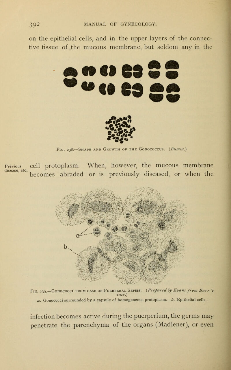 on the epithelial cells, and in the upper layers of the connec- tive tissue of .the mucous membrane, but seldom any in the woesSS wag:: Fig. 238.—Shape and Gkowth of the Gonococcus. (Bumm.) Previous cell protoplasm. When, however, the mucous membrane disease, etc. . .... . t . becomes abraded or is previously diseased, or when the Fig. 239.—Gonococci from case of Puerperal Sepsis. {Prepared by Evans from Burr's case.) a. Gonococci surrounded by a capsule of homogeneous protoplasm, b. Epithelial cells. infection becomes active during the puerperium, the germs may penetrate the parenchyma of the organs (Madlener), or even