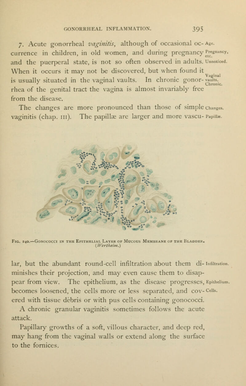 7. Acute gonorrheal vaginitis, although of occasional oc- Age. currence in children, in old women, and during pregnancy|^gnancy« and the puerperal state, is not so often observed in adults. Unnoticed. When it occurs it may not be discovered, but when found it . Vaginal is usually situated in the vaccinal vaults. In chronic gonor- vaults. J & ° Chronic. rhea of the genital tract the vagina is almost invariably free too * from the disease. The changes are more pronounced than those of simple changes, vaginitis (chap. in). The papillae are larger and more vascu- Papiu*. *« ..<#v»'A.,,. 4»*€f&»« Fig. 240.—Gonococci in the Epithelial Layer of Mucous Membrane of the Bladder. (IVertheitti.) lar, but the abundant round-cell infiltration about them di-infiltration, minishes their projection, and may even cause them to disap- pear from view. The epithelium, as the disease progresses, Epithelium, becomes loosened, the cells more or less separated, and cov-Cciis. ered with tissue debris or with pus cells containing gonococci. A chronic granular vaginitis sometimes follows the acute attack. Papillary growths of a soft, villous character, and deep red, may hang from the vaginal walls or extend along the surface to the fornices.