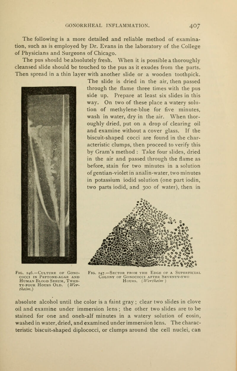 The following is a more detailed and reliable method of examina- tion, such as is employed by Dr. Evans in the laboratory of the College of Physicians and Surgeons of Chicago. The pus should be absolutely fresh. When it is possible a thoroughly cleansed slide should be touched to the pus as it exudes from the parts. Then spread in a thin layer with another slide or a wooden toothpick. The slide is dried in the air, then passed through the flame three times with the pus side up. Prepare at least six slides in this way. On two of these place a watery solu- tion of methylene-blue for five minutes, wash in water, dry in the air. When thor- oughly dried, put on a drop of clearing oil and examine without a cover glass. If the biscuit-shaped cocci are found in the char- acteristic clumps, then proceed to verify this by Gram's method : Take four slides, dried in the air and passed through the flame as before, stain for two minutes in a solution of gentian-violet in analin-water, two minutes in potassium iodid solution (one part iodin, two parts iodid, and 300 of water), then in Fig. 246.—Culture of Gono- cocci in Peptone-agar and Human Blood Serum, Twen- ty-four Hours Old. {Wer- theim.) Fig. 247.—Sector from the Edge of a Superficial Colony of Gonococci after Seventy-two Hours. {Wertheim ) absolute alcohol until the color is a faint gray ; clear two slides in clove oil and examine under immersion lens ; the other two slides are to be stained for one and oneh-alf minutes in a watery solution of eosin, washed in water, dried, and examined under immersion lens. The charac- teristic biscuit-shaped diplococci, or clumps around the cell nuclei, can