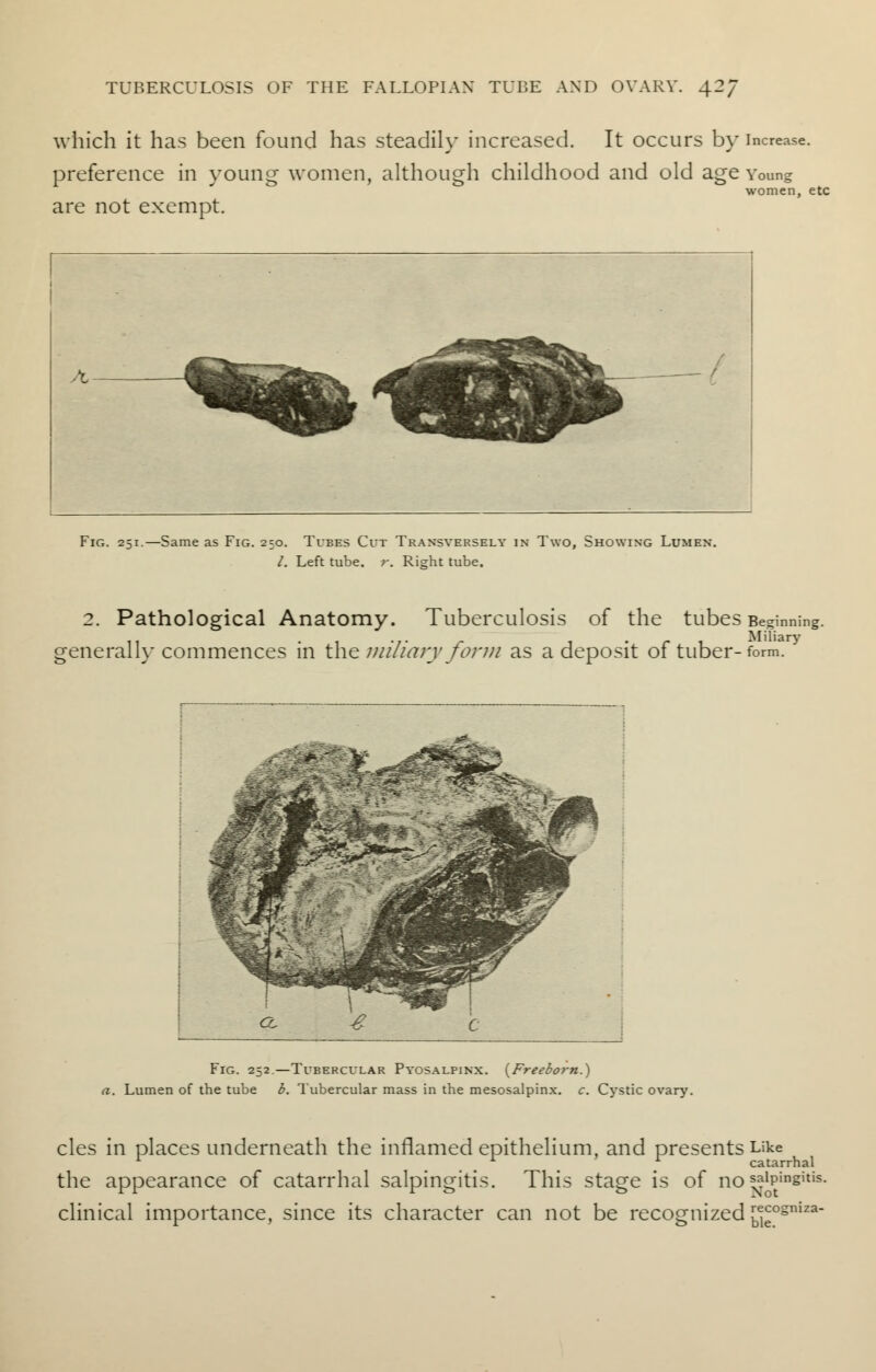 which it has been found has steadily increased. It occurs by increase, preference in young women, although childhood and old age Young women, etc are not exempt. Fig. 251.—Same as Fig. 250. Tubes Cut Transversely in Two, Showing Lumen. /. Left tube. r. Right tube. 2. Pathological Anatomy. Tuberculosis of the tubes Beginning, generally commences in the miliary form as a deposit of tuber-form. Fig. 252.—Tubercular Pyosalpinx. {Freeborn.') a. Lumen of the tube b. Tubercular mass in the mesosalpinx, c. Cystic ovary. cles in places underneath the inflamed epithelium, and presents Like 1 x x catarrhal the appearance of catarrhal salpingitis. This stage is of no salpingitis. clinical importance, since its character can not be recognized j^ogniza-