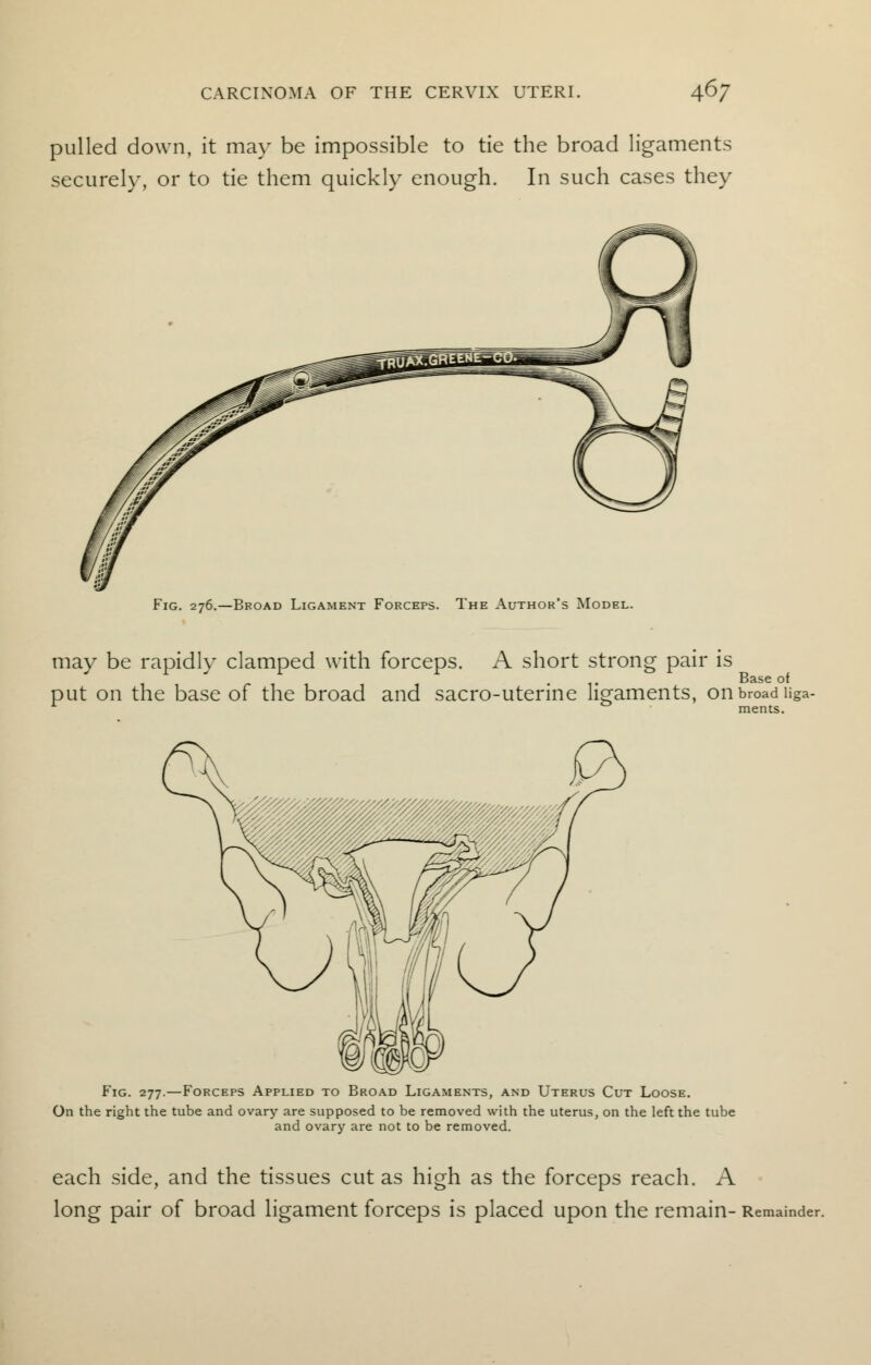 pulled down, it may be impossible to tie the broad ligaments securely, or to tie them quickly enough. In such cases they Fig. 276.—Broad Ligament Forceps. The Author's Model. may be rapidly clamped with forceps. A short strong pair is ... Base of put on the base of the broad and sacro-uterme ligaments, on broad uga- Fig. 277.—Forceps Applied to Broad Ligaments, and Uterus Cut Loose. On the right the tube and ovary are supposed to be removed with the uterus, on the left the tube and ovary are not to be removed. each side, and the tissues cut as high as the forceps reach. A long pair of broad ligament forceps is placed upon the remain- Remainder.