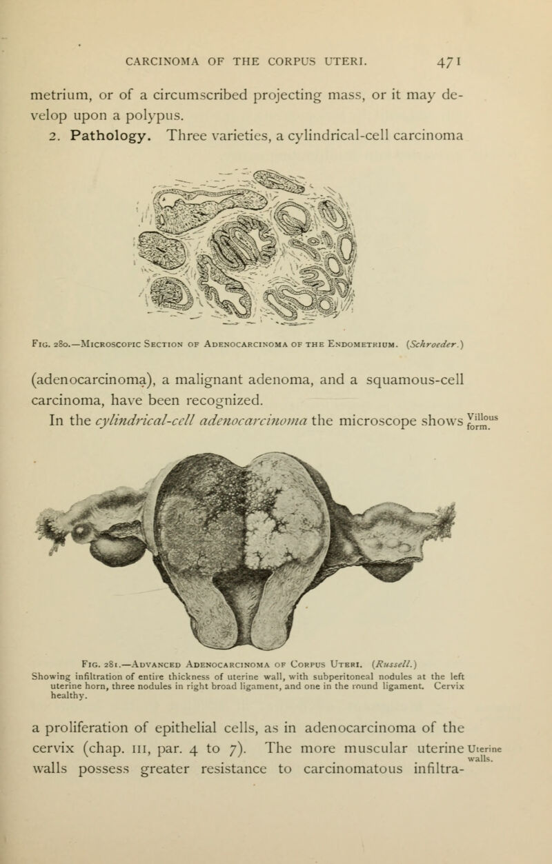 metrium, or of a circumscribed projecting mass, or it may de- velop upon a polypus. 2. Pathology. Three varieties, a cylindrical-cell carcinoma Fig. 280.—Microscopic Section of Adenocarcinoma of the Endometrium. (Schroeder.) (adenocarcinoma), a malignant adenoma, and a squamous-cell carcinoma, have been recognized. In the cylindrical-cell adenocarcinoma the microscope shows JQ^US Fig. 281.—Advanced Adenocarcinoma of Corpus Uteri. (Russell.) Showing infiltration of entire thickness of uterine wall, with subperitoneal nodules at the left uterine horn, three nodules in right broad ligament, and one in the round ligament. Cervix healthy. a proliferation of epithelial cells, as in adenocarcinoma of the cervix (chap, in, par. 4 to 7). The more muscular uterine Uterine 11 • • • r, waUs- walls possess greater resistance to carcinomatous lnfiltra-