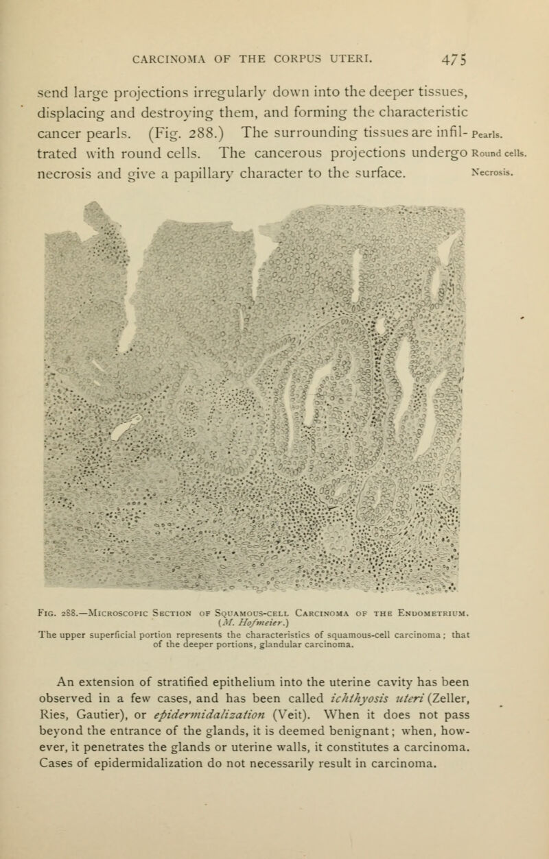 send large projections irregularly down into the deeper tissues, displacing and destroying them, and forming the characteristic cancer pearls. (Fig. 288.) The surrounding tissues are infil- Pearls, trated with round cells. The cancerous projections undergo Round ceils, necrosis and give a papillary character to the surface. Necrosis. ., • ■' ' ••• : •' Fig. 288.—Microscopic Section of Sqcamots-cell Carcinoma of the Endometrium. {M. Hofmeier.) The upper superficial portion represents the characteristics of squamous-cell carcinoma; that of the deeper portions, glandular carcinoma. An extension of stratified epithelium into the uterine cavity has been observed in a few cases, and has been called ichthyosis uteri (Zeller, Ries, Gautier), or epidermidalization (Veit). When it does not pass beyond the entrance of the glands, it is deemed benignant; when, how- ever, it penetrates the glands or uterine walls, it constitutes a carcinoma. Cases of epidermidalization do not necessarily result in carcinoma.