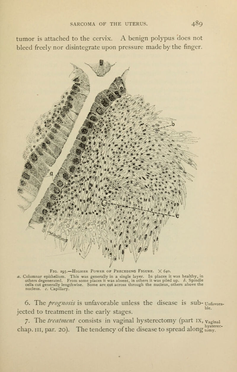tumor is attached to the cervix. A benign polypus does not bleed freely nor disintegrate upon pressure made by the finger. -* -* a Jmm ■■* i 5 *?> 7 li < -' . *•. ■ *• # '• / I '.; 4 4  : » • • $ £ . 61 . ^|J ^ ? P V ' 5 Fig. 295.—Higher Power of Preceding Figure. X 640. a. Columnar epithelium. This was generally in a single layer. In places it was healthy, in others degenerated. From some places it was absent, in others it was piled up. b. Spindle cells cut generally lengthwise. Some are cut across through the nucleus, others above the nucleus, c. Capillary. 6. The prognosis is unfavorable unless the disease is sub- unfevora- jected to treatment in the early stages. 7. The treatment consists in vaginal hysterectomy (part ix, vaginal chap, in, par. 20). The tendency of the disease to spread along tomy.