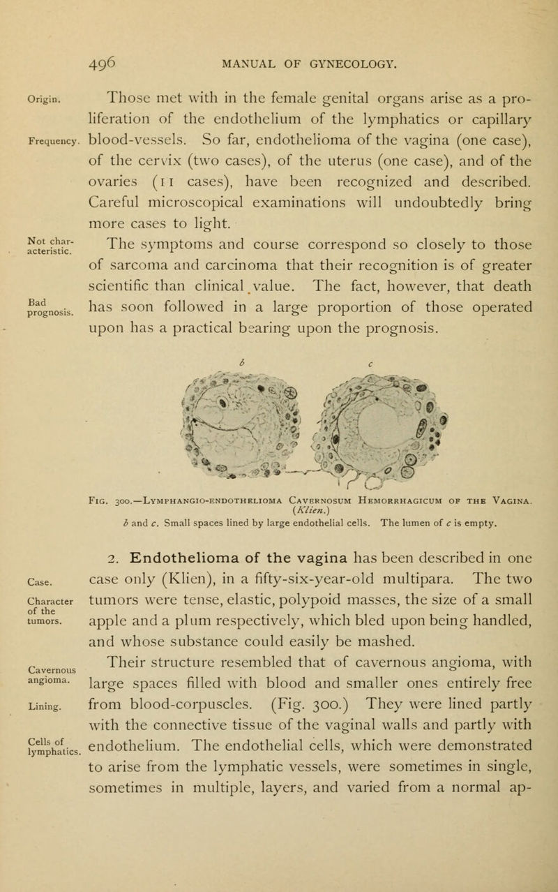 Not char- acteristic. Bad prognosis. Origin. Those met with in the female genital organs arise as a pro- liferation of the endothelium of the lymphatics or capillary Frequency, blood-vessels. So far, endothelioma of the vagina (one case), of the cervix (two cases), of the uterus (one case), and of the ovaries (11 cases), have been recognized and described. Careful microscopical examinations will undoubtedly bring more cases to light. The symptoms and course correspond so closely to those of sarcoma and carcinoma that their recognition is of greater scientific than clinical value. The fact, however, that death has soon followed in a large proportion of those operated upon has a practical bearing upon the prognosis. *•* fat \% w • r u*' Fig. 300.—Lymphangioendothelioma Cavernosum Hemorrhagicum of the Vagina. (Klien.) b and c. Small spaces lined by large endothelial cells. The lumen of c is empty. Case. Character of the tumors. Cavernous angioma. Lining. Cells of lymphatics. 2. Endothelioma of the vagina has been described in one case only (Klien), in a fifty-six-year-old multipara. The two tumors were tense, elastic, polypoid masses, the size of a small apple and a plum respectively, which bled upon being handled, and whose substance could easily be mashed. Their structure resembled that of cavernous angioma, with large spaces filled with blood and smaller ones entirely free from blood-corpuscles. (Fig. 300.) They were lined partly with the connective tissue of the vaginal walls and partly with endothelium. The endothelial cells, which were demonstrated to arise from the lymphatic vessels, were sometimes in single, sometimes in multiple, layers, and varied from a normal ap-