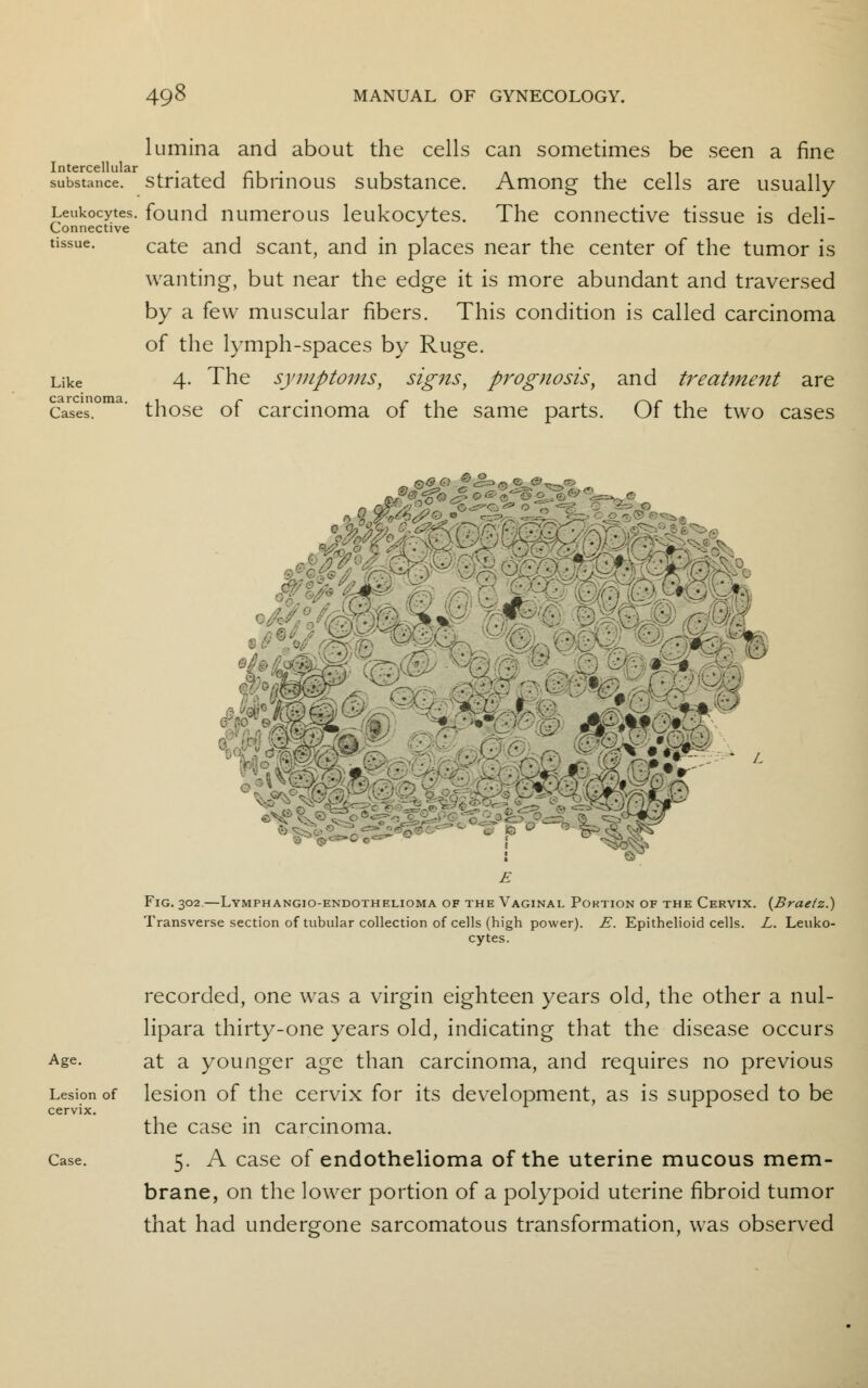 lumina and about the cells can sometimes be seen a fine Intercellular , _. substance, striated fibrinous substance. Among the cells are usually Leukocytes, found numerous leukocytes. The connective tissue is deli- Connective y tissue. cate anci scailt) and in places near the center of the tumor is wanting, but near the edge it is more abundant and traversed by a few muscular fibers. This condition is called carcinoma of the lymph-spaces by Ruge. Like 4- The symptoms, signs, prognosis, and treatment are cases. ' those of carcinoma of the same parts. Of the two cases Q&C) ^ £?<^ ofi> SI #-:*, fo^-%^ w Fig. 302.—Lymphangio-endothelioma of the Vaginal Portion of the Cervix. (Brae/z.) Transverse section of tubular collection of cells (high power). E. Epithelioid cells. L. Leuko- cytes. Age. Lesion of cervix. Case. recorded, one was a virgin eighteen years old, the other a nul- lipara thirty-one years old, indicating that the disease occurs at a younger age than carcinoma, and requires no previous lesion of the cervix for its development, as is supposed to be the case in carcinoma. 5. A case of endothelioma of the uterine mucous mem- brane, on the lower portion of a polypoid uterine fibroid tumor that had undergone sarcomatous transformation, was observed